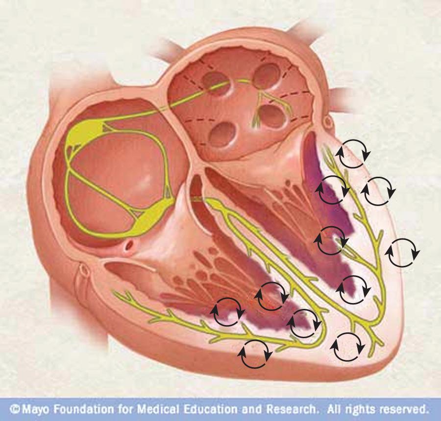 Figure 12.2, During ventricular fibrillation, chaotic electromechanical activity prevents the ventricle from ejecting blood into the circulation. Defibrillation passes a therapeutic burst of current through the myocardium and terminates this activity.