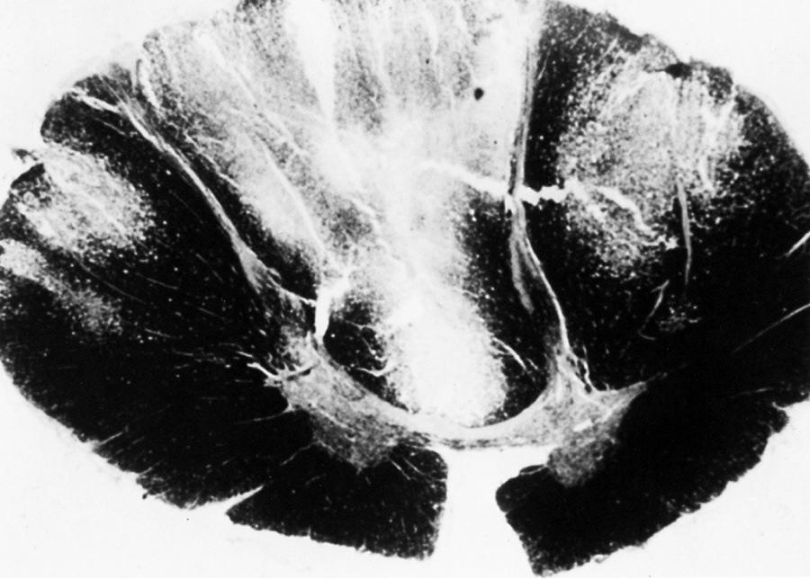 Fig. 85.2, Subacute Combined Degeneration of the Spinal Cord in Vitamin B 12 Deficiency.