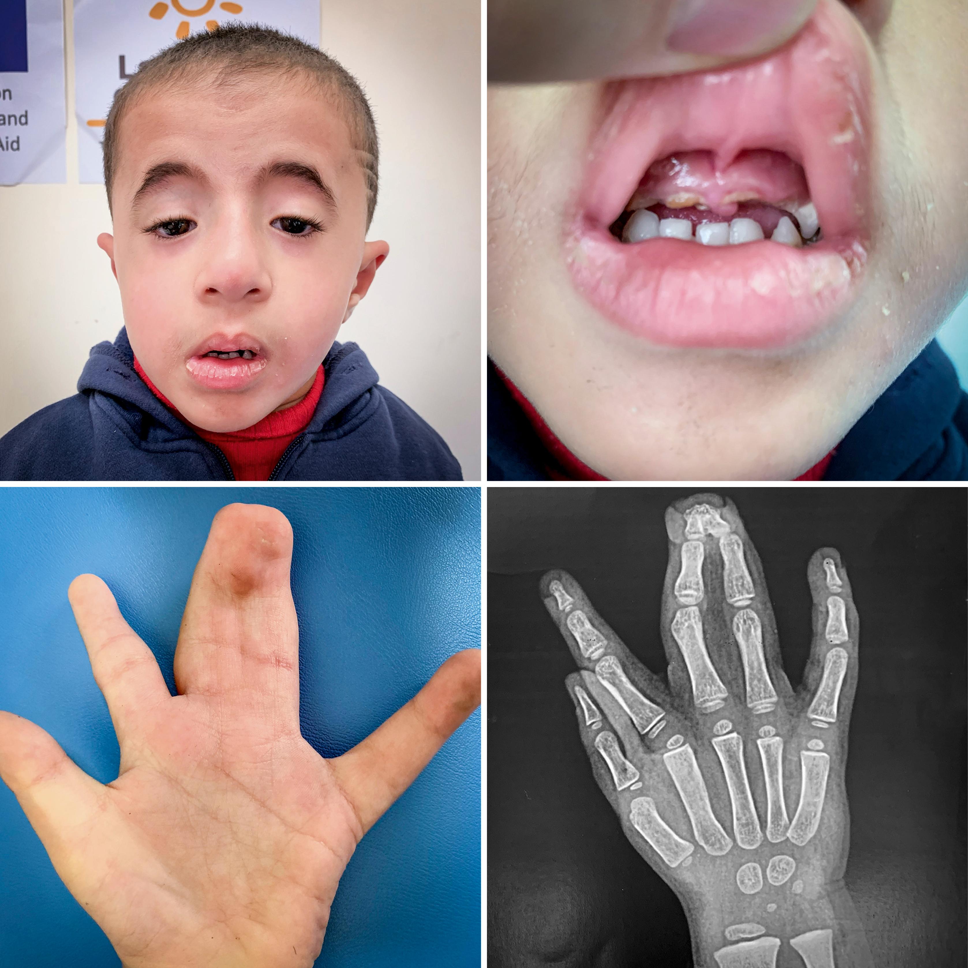 Fig. 36.1, Oculodentodigital dysplasia showing a typical face, carious teeth, and complex syndactyly.