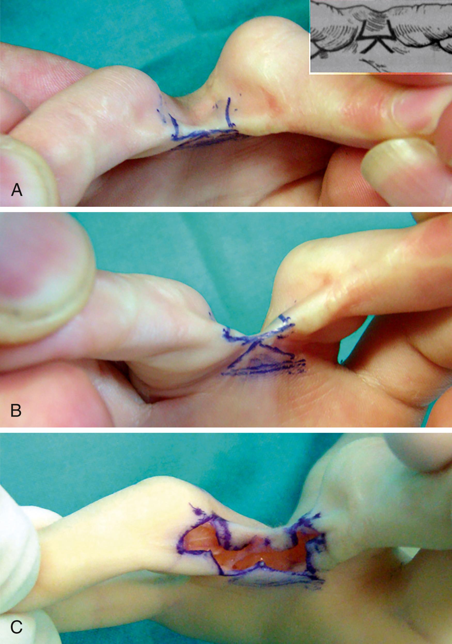 Fig. 36.12, Very short partial syndactyly ( A and B ), separated without need of a skin graft using a butterfly Z-plasty (C) .