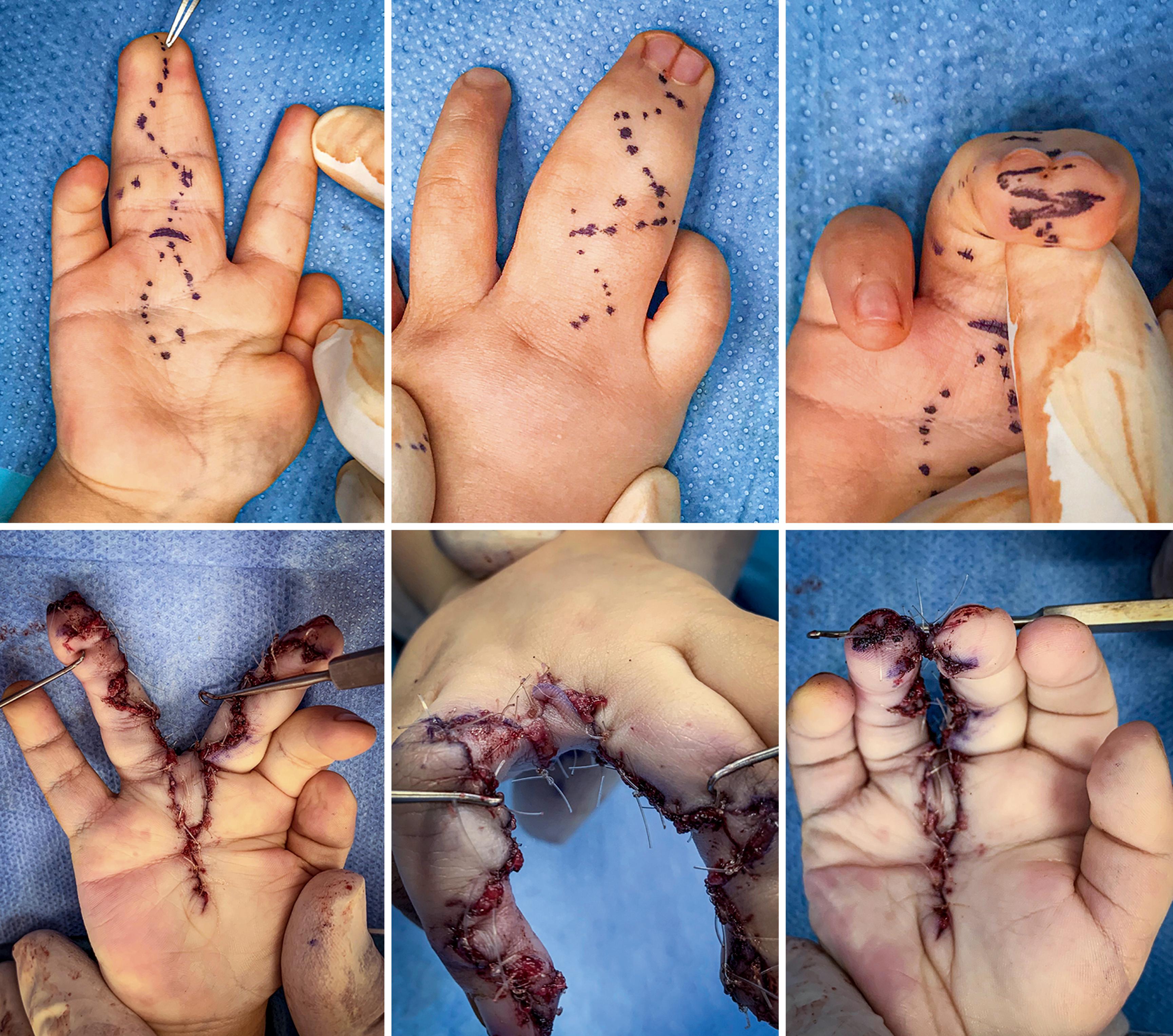 Fig. 36.13, Syndactyly reconstruction using a novel graftless technique with a volar intermetacarpal flap.