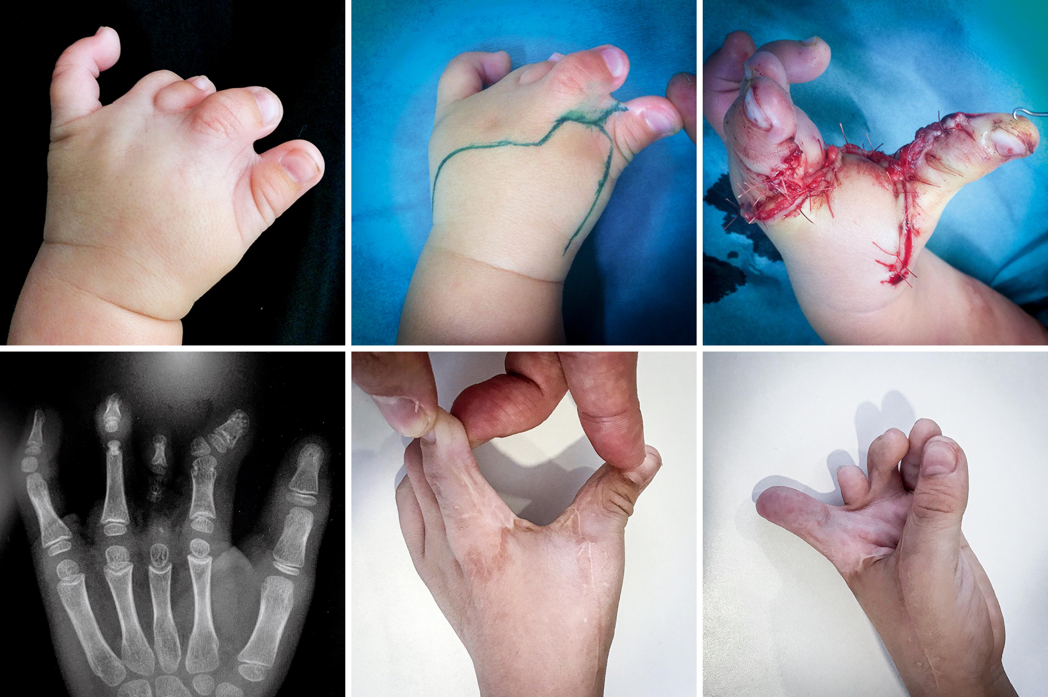 Fig. 36.16, First web syndactyly should also be separated early to avoid tethering deformities and restore patient’s thumb pinch. Here a modified dorsal rotation advancement flap has been used to correct syndactyly.