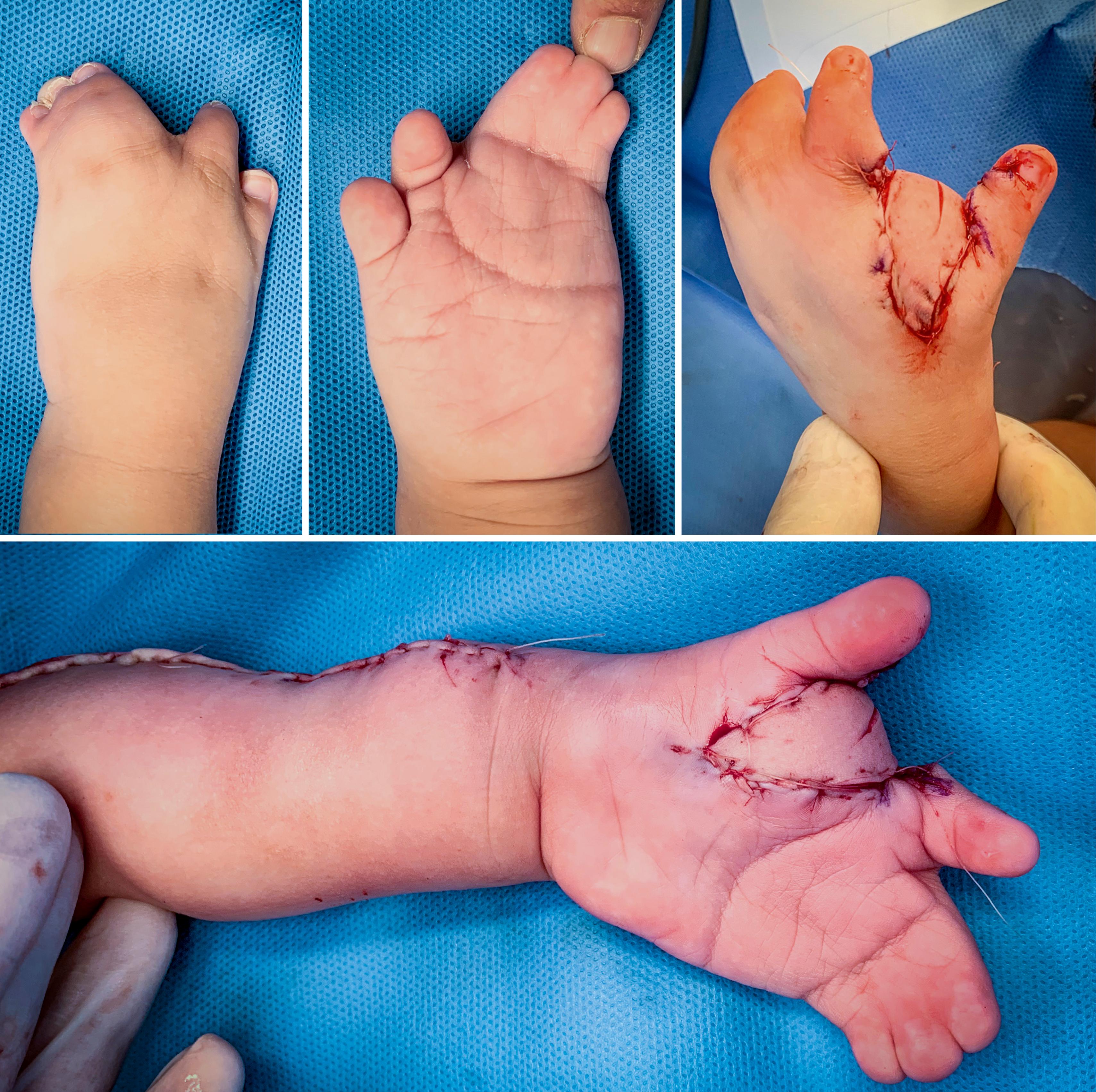 Fig. 36.17, Syndromic multiple syndactyly. First web was reconstructed using a pedicled retrograde radial flap obtaining a wide first web and a direct forearm skin closure.