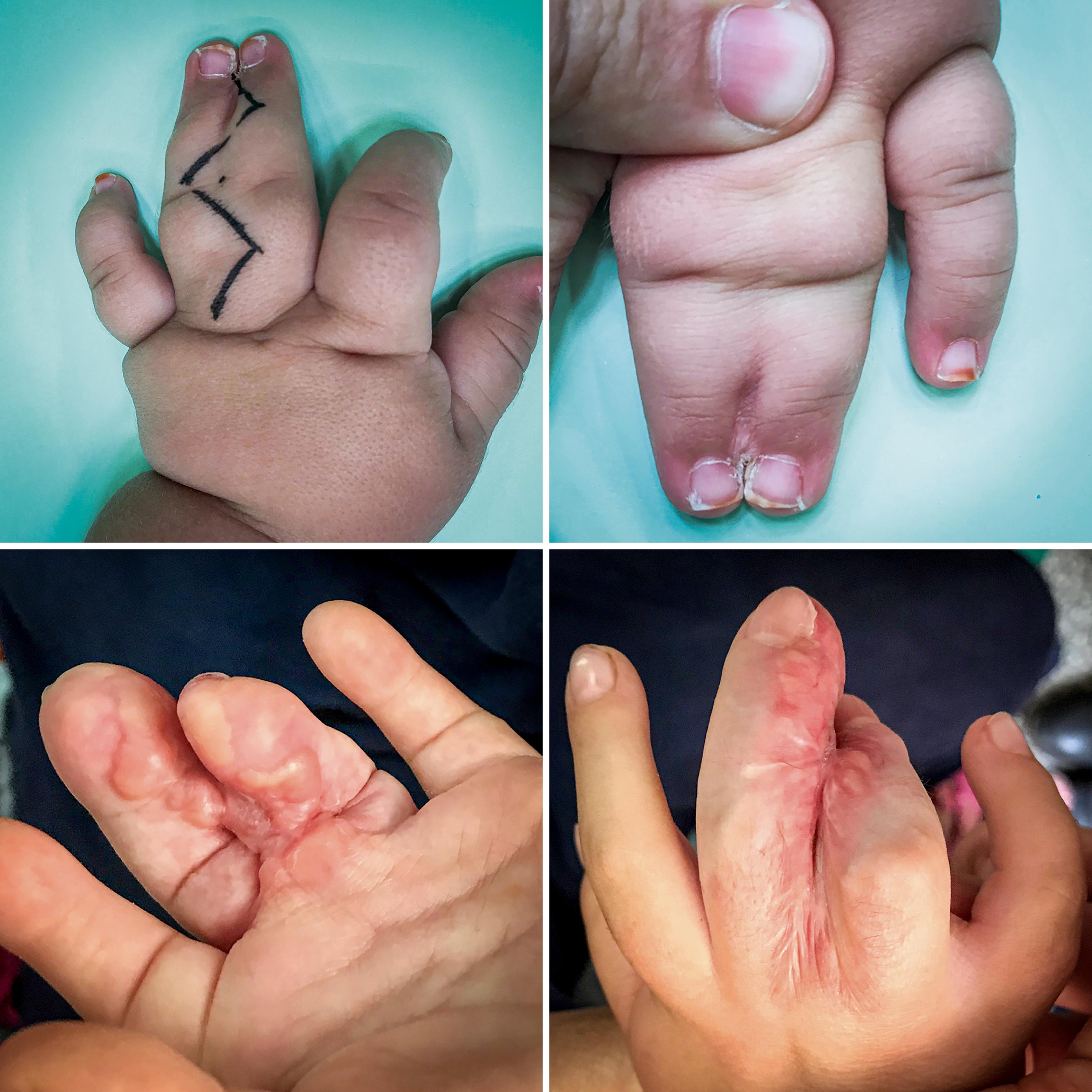 Fig. 36.18, Syndactyly with enlarged digits and edematous orange-like skin is at risk of developing hypertrophic or keloid scarring after surgical release. Preoperative low-dose methotrexate treatment can prevent this complication.