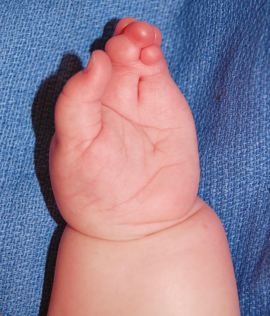 Fig. 36.19, Acrosyndactyly in constriction ring sequence with a sinus tract or cleft from the dorsal to the palmar surface of the conjoined digits.