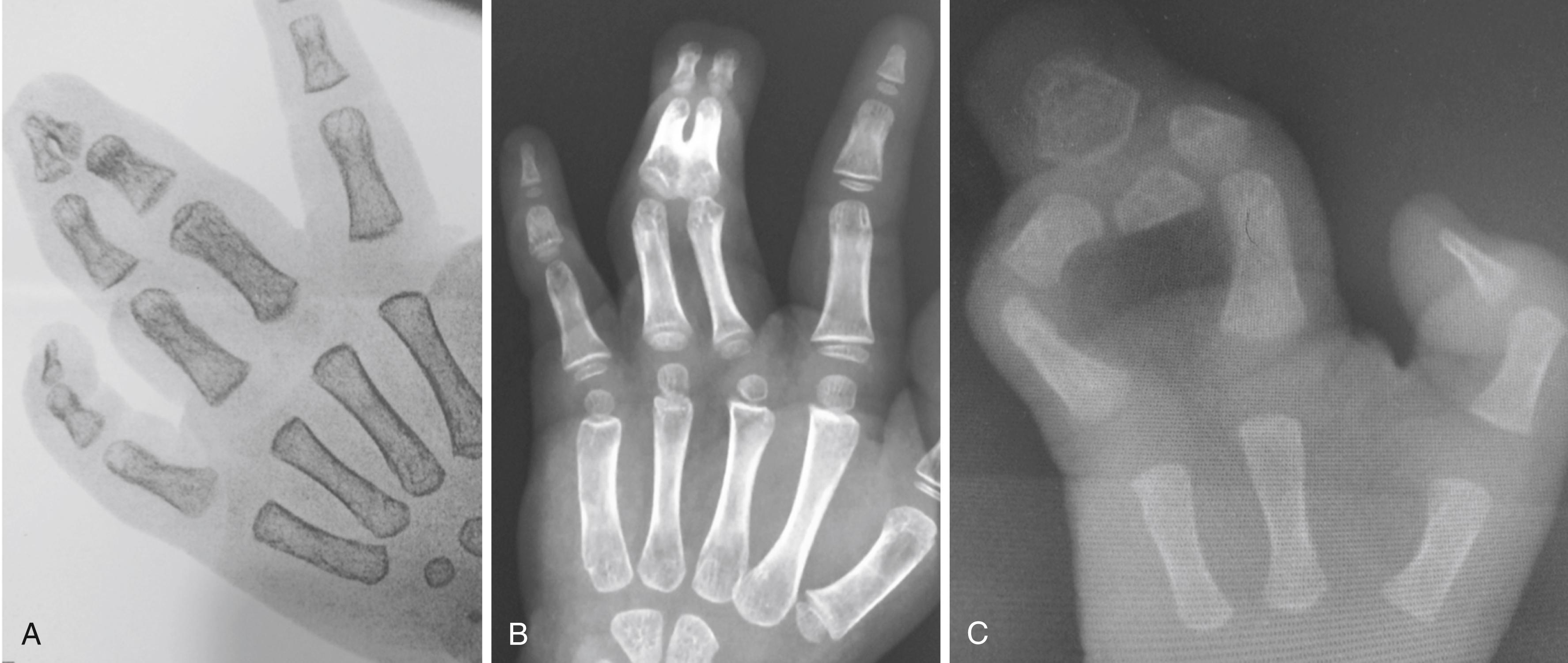 Fig. 36.2, Complex syndactyly is associated with bone union, most commonly the third phalangeal tuft (A) , although other parts of the phalanx can be involved (B) . Complicated syndactyly exhibiting disorganized bone tissue connecting adjacent fingers (C) .