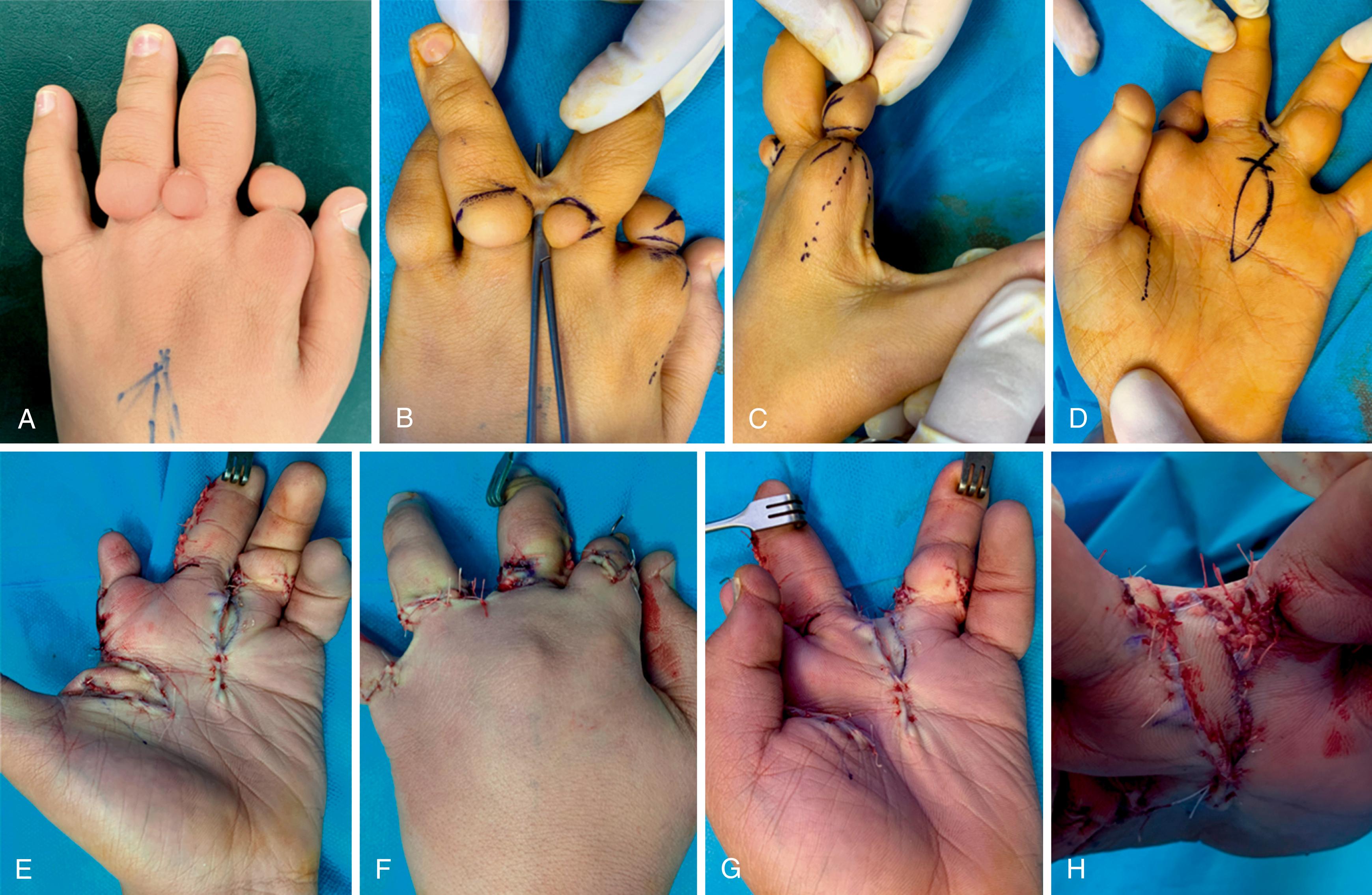 Fig. 36.21, A to H, Constriction ring sequence combining pseudosyndactyly, amputations, constriction rings, dorsal cutaneous nubbins, and first web contracture. Index constriction was released with hemiresection and Z-plasty, syndactyly was released using a vascularized volar intermetacarpal flap, nubbins were resected, and, finally, first web was reconstructed using a Stiletto flap.