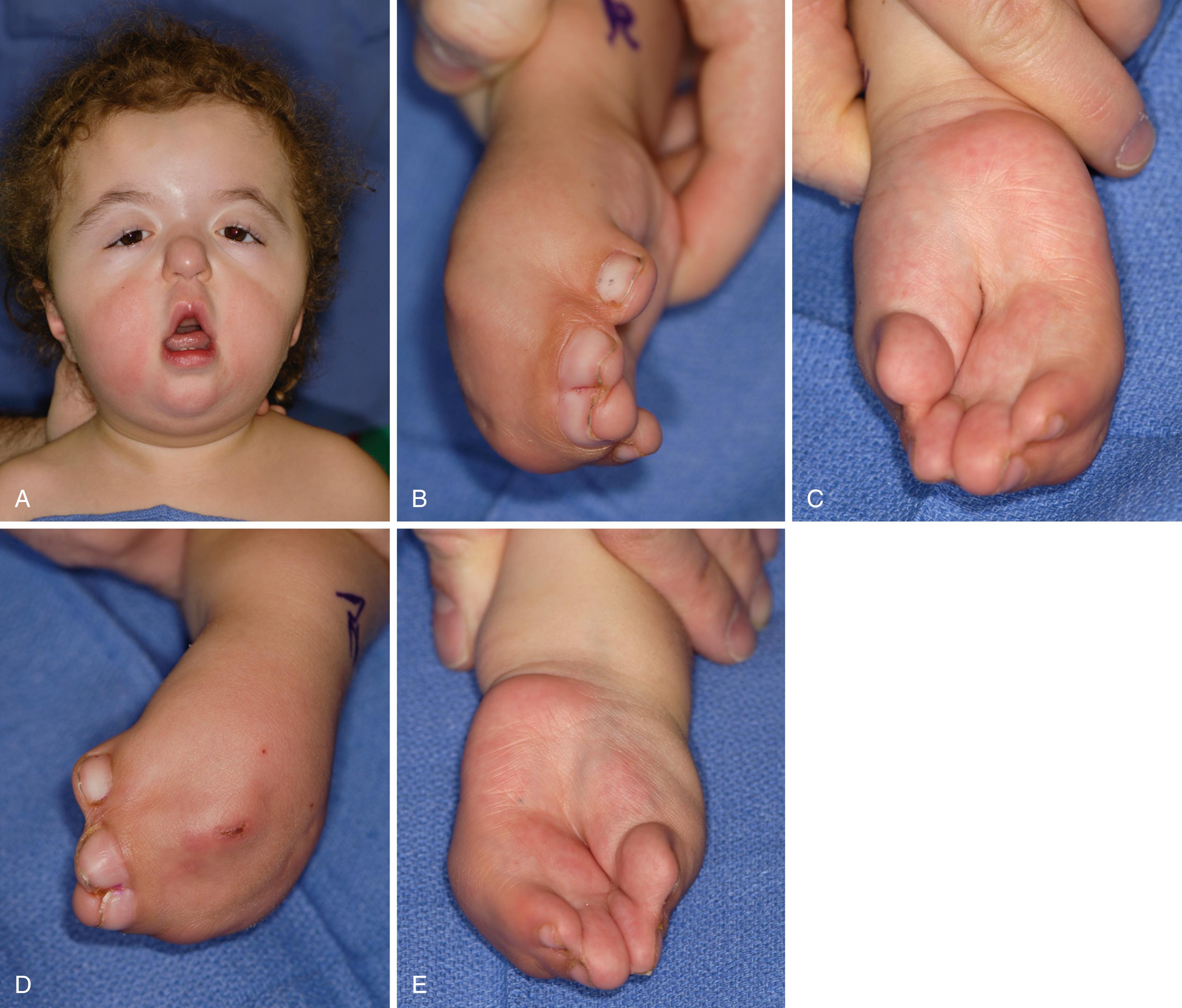 Fig. 36.22, A to E, Complex multiple syndactyly associated with Apert syndrome. The hand deformity includes complex syndactyly of the index, long, and ring fingers; simple syndactyly between the ring and small fingers; and an incomplete first web space.