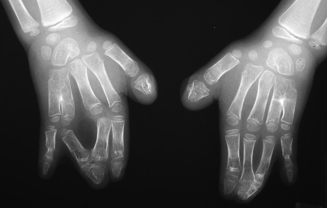 Fig. 36.23, Bilateral hand x-rays of a child with Apert syndrome. Note the coronal complex syndactyly of the distal ends of the central digits, capitohamate coalitions, and synostosis between the ring and small finger metacarpals.