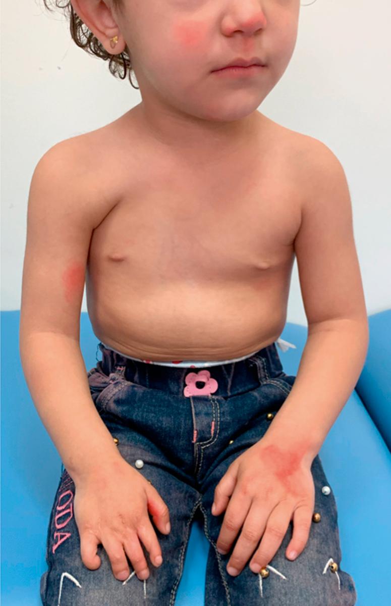 Fig. 36.28, Poland syndrome with a complete absence of the pectoralis major muscle, hand size discrepancy, and a released symbrachydactyly.