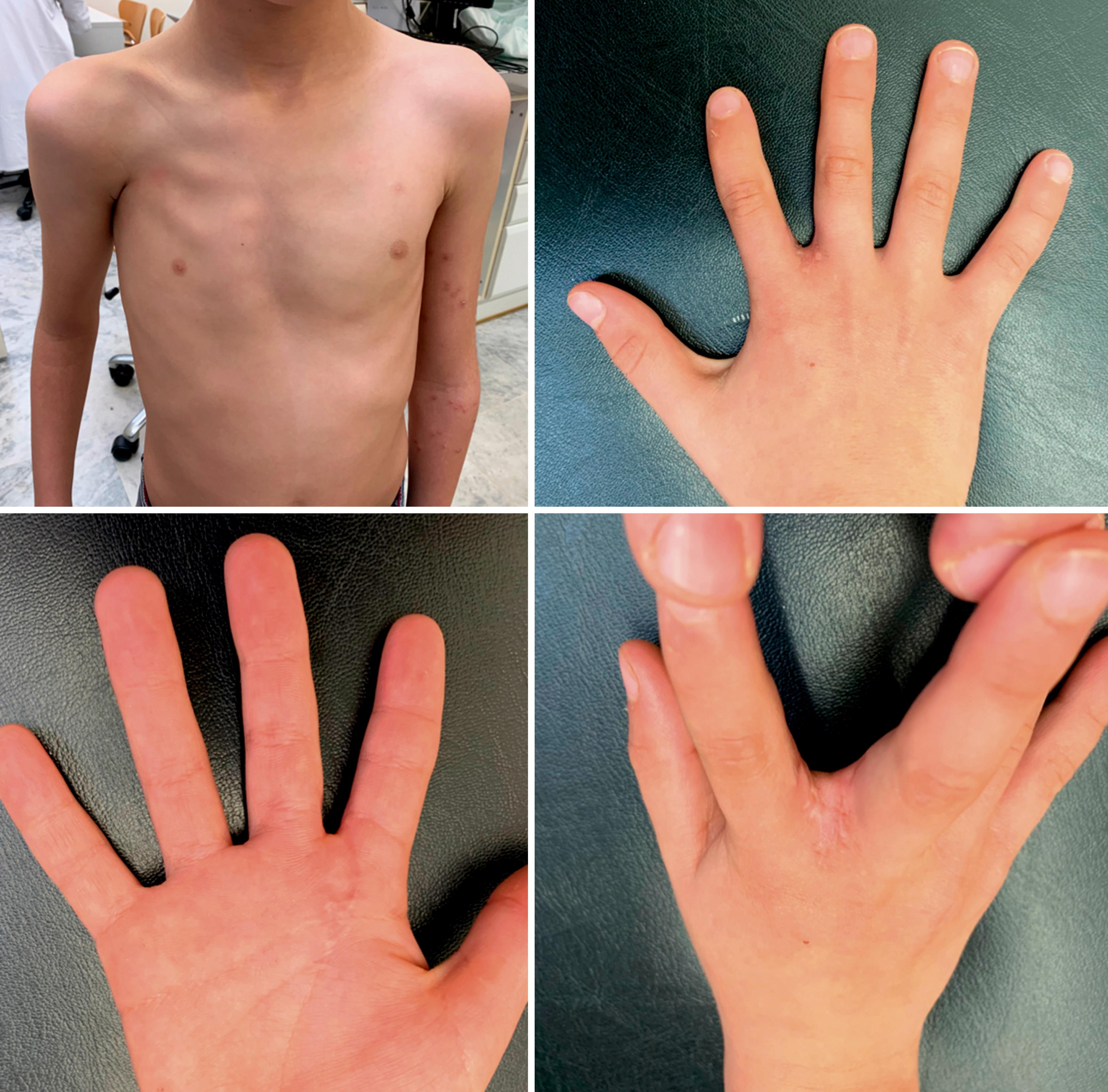 Fig. 36.29, Poland syndrome with a complete absence of the pectoralis major muscle. A partial second web syndactyly was released using a graftless volar intermetacarpal flap technique.