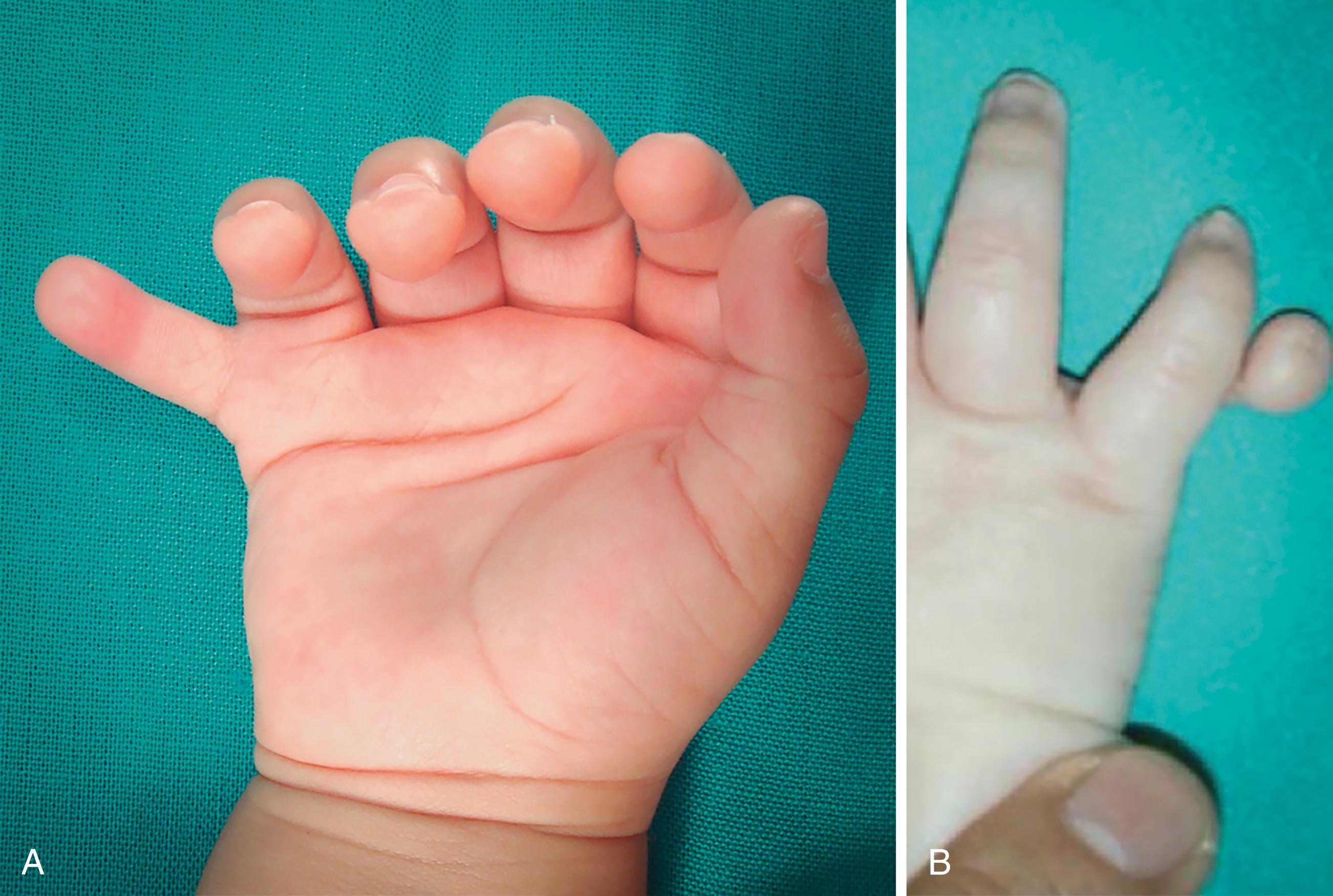 Fig. 36.30, A, Type A is a fully developed postaxial polydactyly. In white children it might be part of a syndrome and warrants a systemic evaluation. Reconstruction is similar to thumb duplication. MCP collateral ligament and intrinsic muscle reinsertion is needed to avoid future complications. B, Type B postaxial polydactyly.