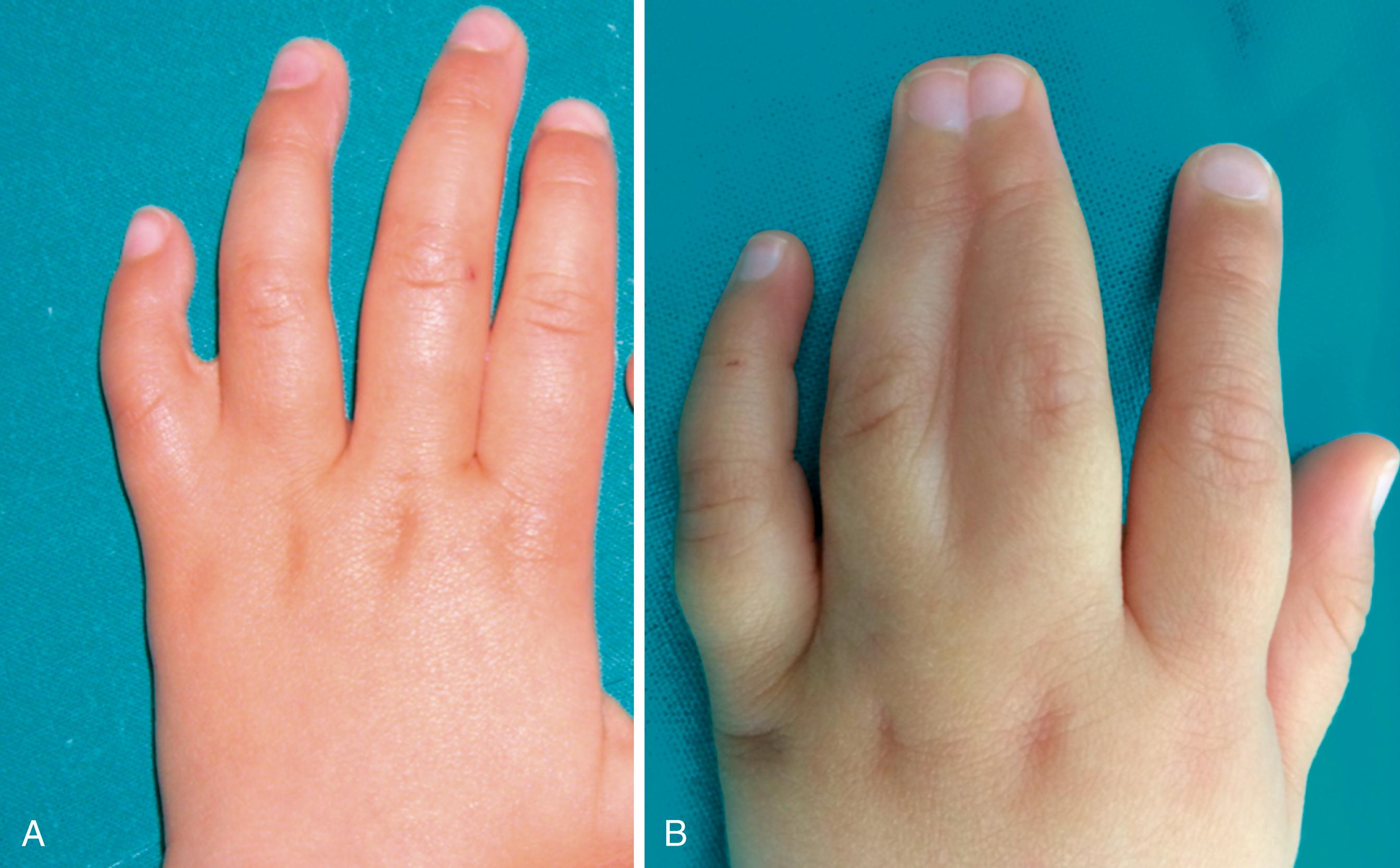 Fig. 36.3, (A) Incomplete syndactyly of fourth commissure. (B) Complete syndactyly involves entire web of third commissure, including nail plates (synonychia).