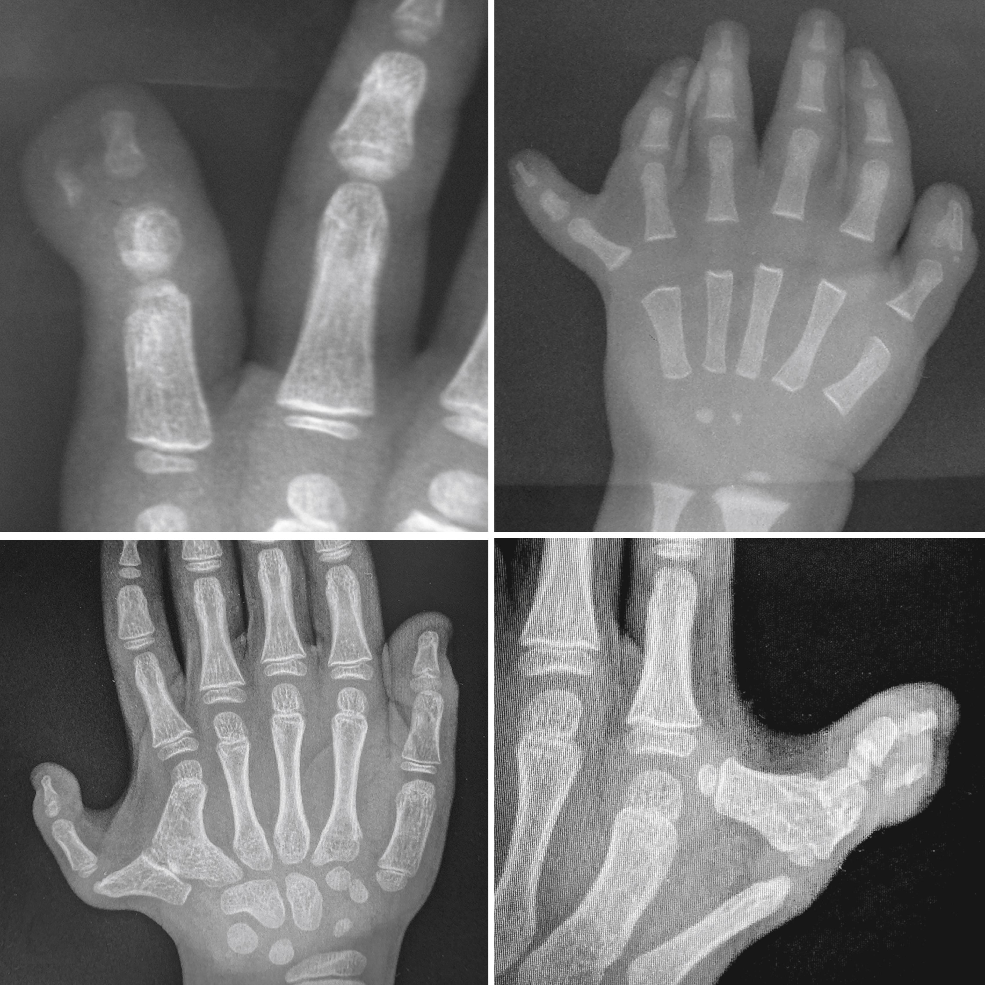 Fig. 36.31, Similar to thumb duplication, postaxial type A polydactyly has variable forms of presentation.
