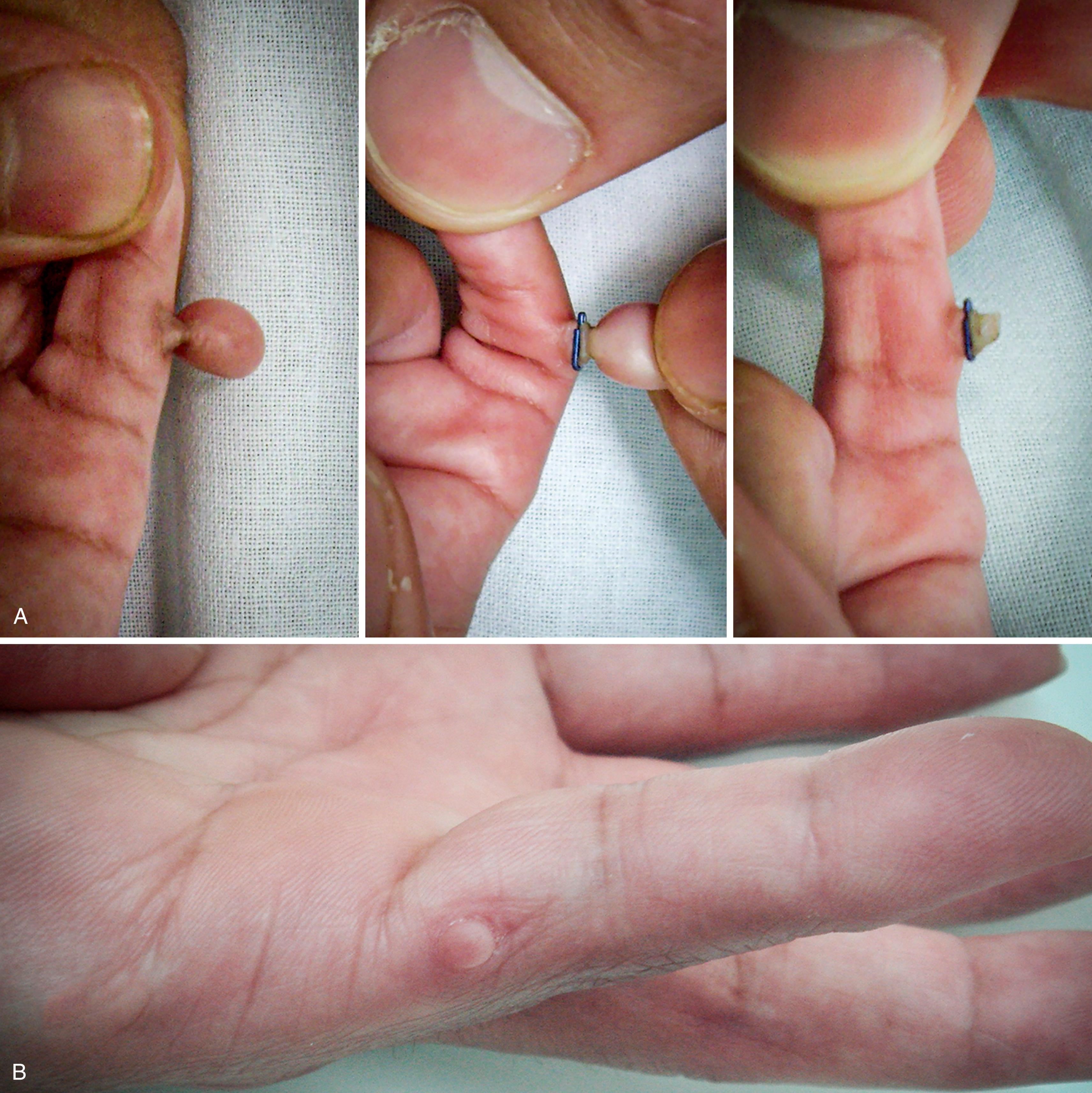 Fig. 36.32, A, Type B postaxial polydactyly treated clipped and removed in the nursery. B, Nubbin remnant from a type B postaxial polydactyly ligated in the nursery.