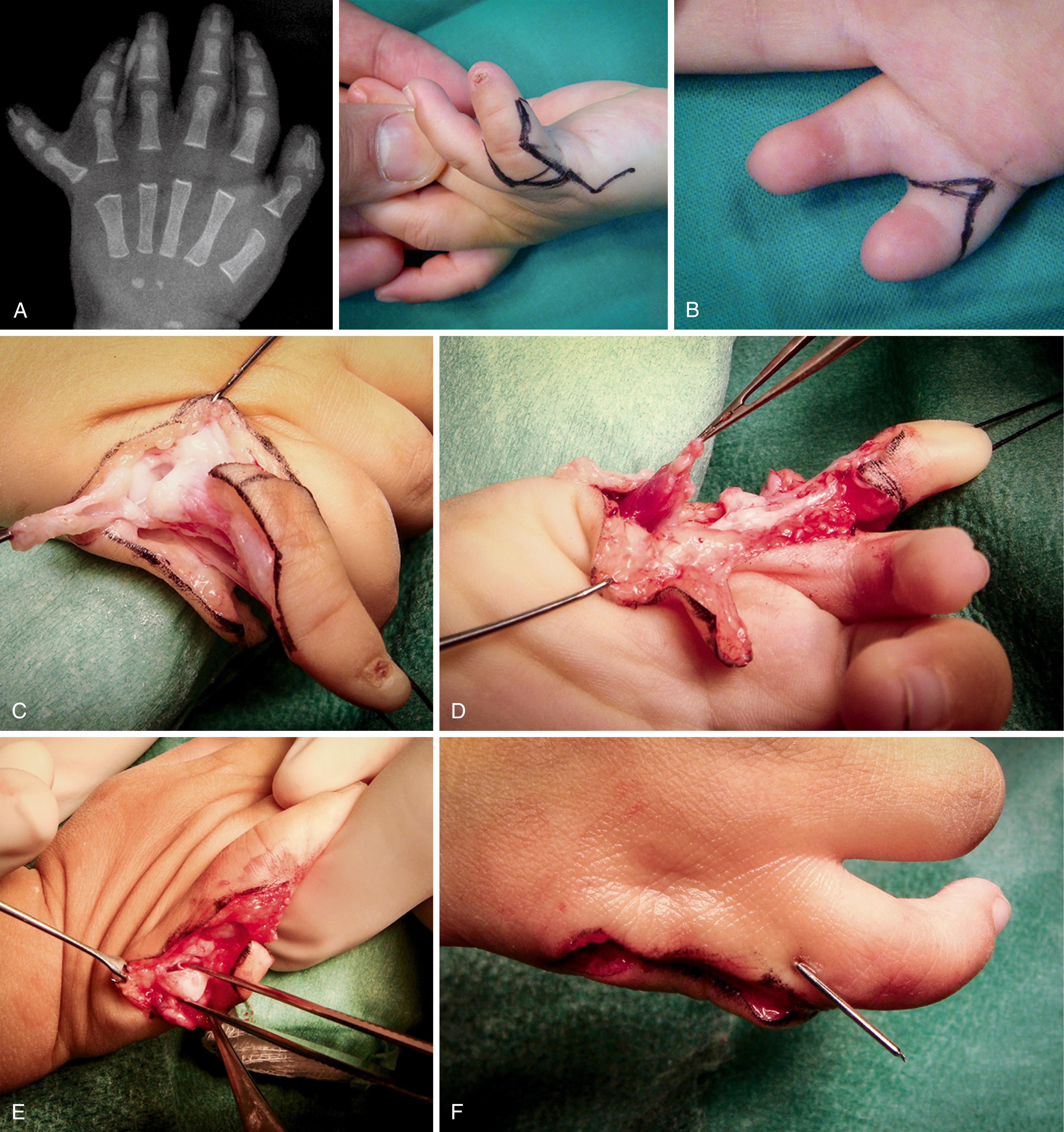 Fig. 36.34, Reconstruction of a type A postaxial polydactyly ( A and B ) including a MCP ulnar collateral ligament and abductor digiti minimi muscle reattachment ( C to F ).