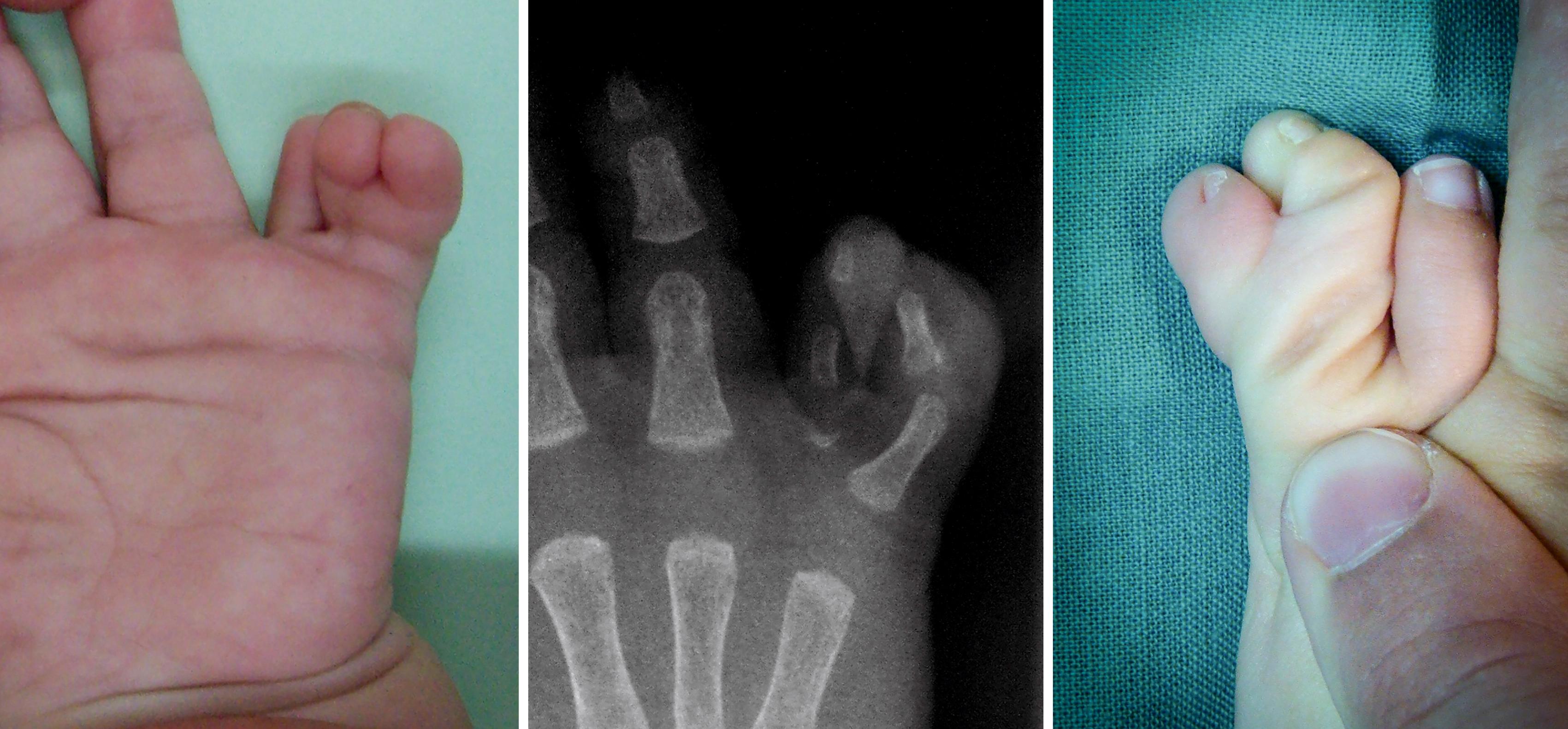 Fig. 36.35, Triplicated type A ulnar polydactyly.