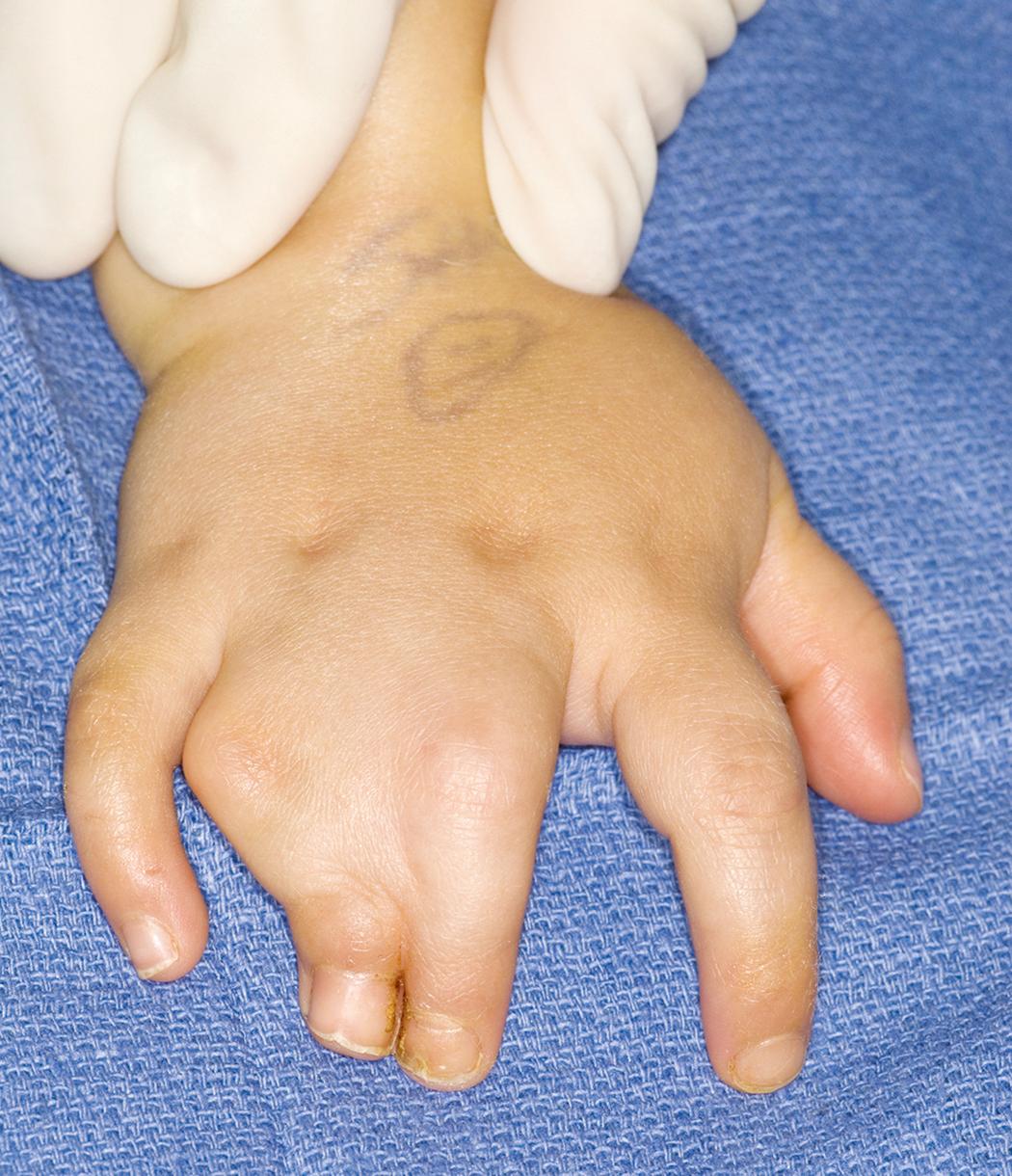 Fig. 36.37, Dorsal view of a 2-year-old girl with familial synpolydactyly.