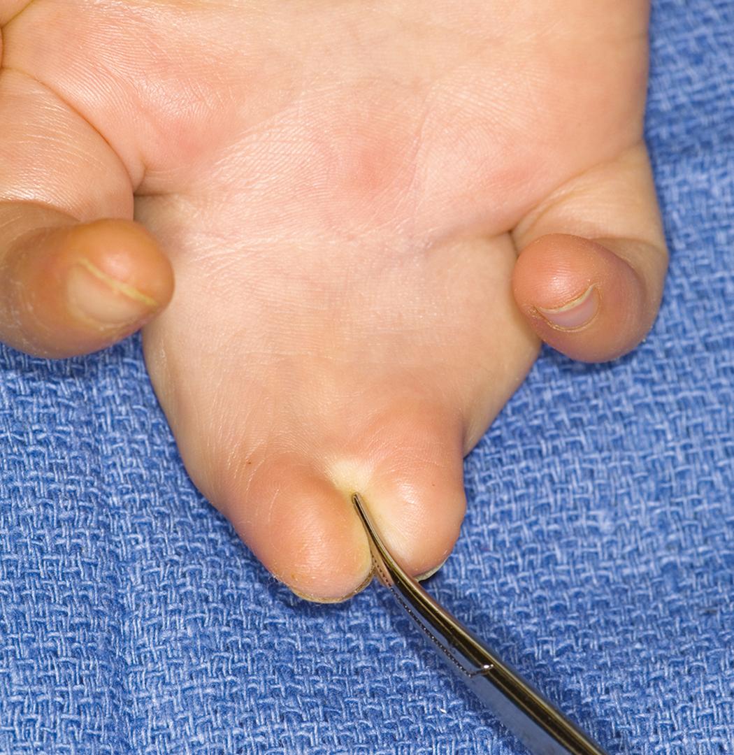 Fig. 36.38, Palmar view of synpolydactyly with a wide base about the proximal phalanges.