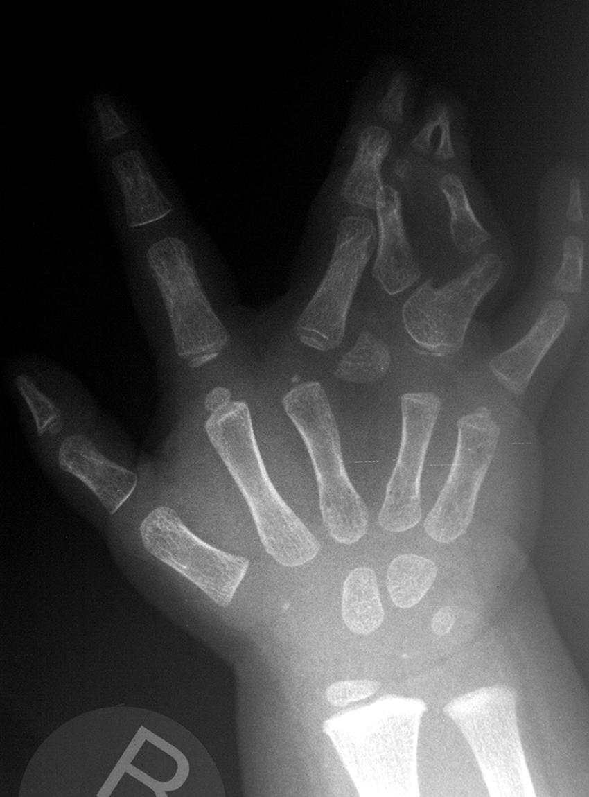 Fig. 36.39, X-ray revealing a concealed ring finger duplication with angular deformities.