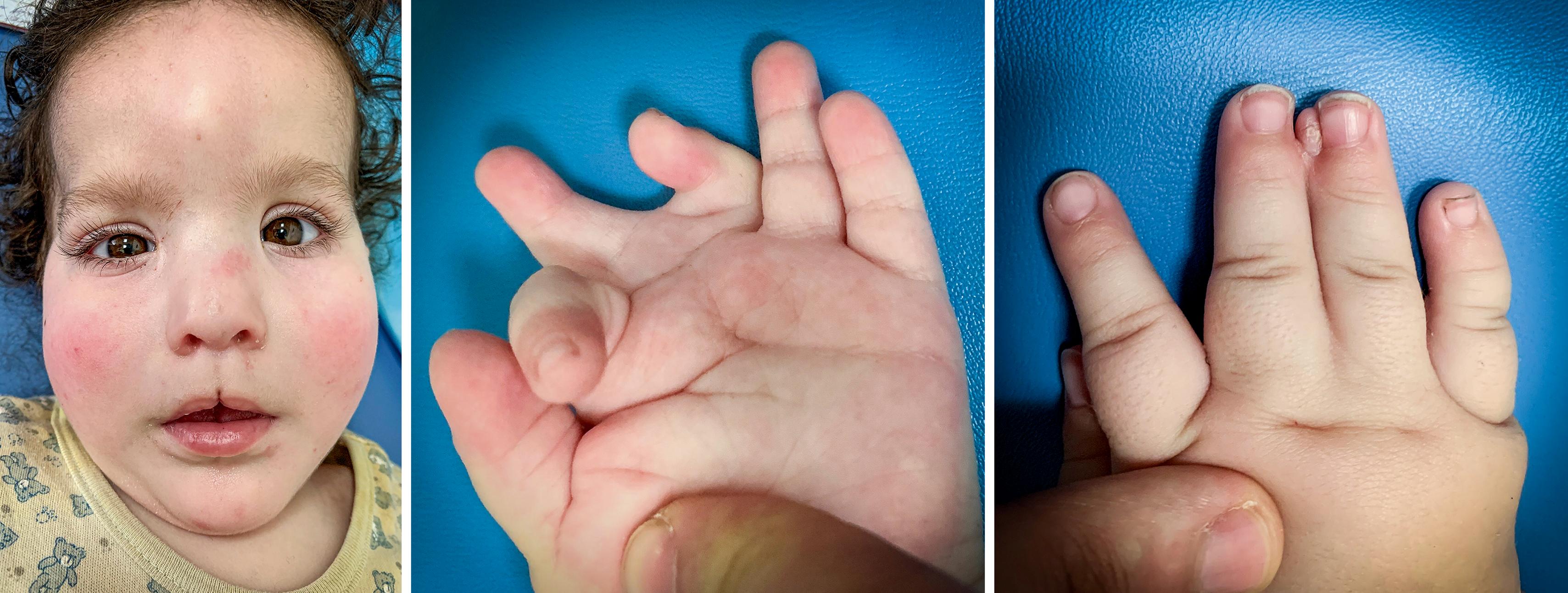 Fig. 36.40, Middle finger polydactyly associated to an acrocallosal syndrome.