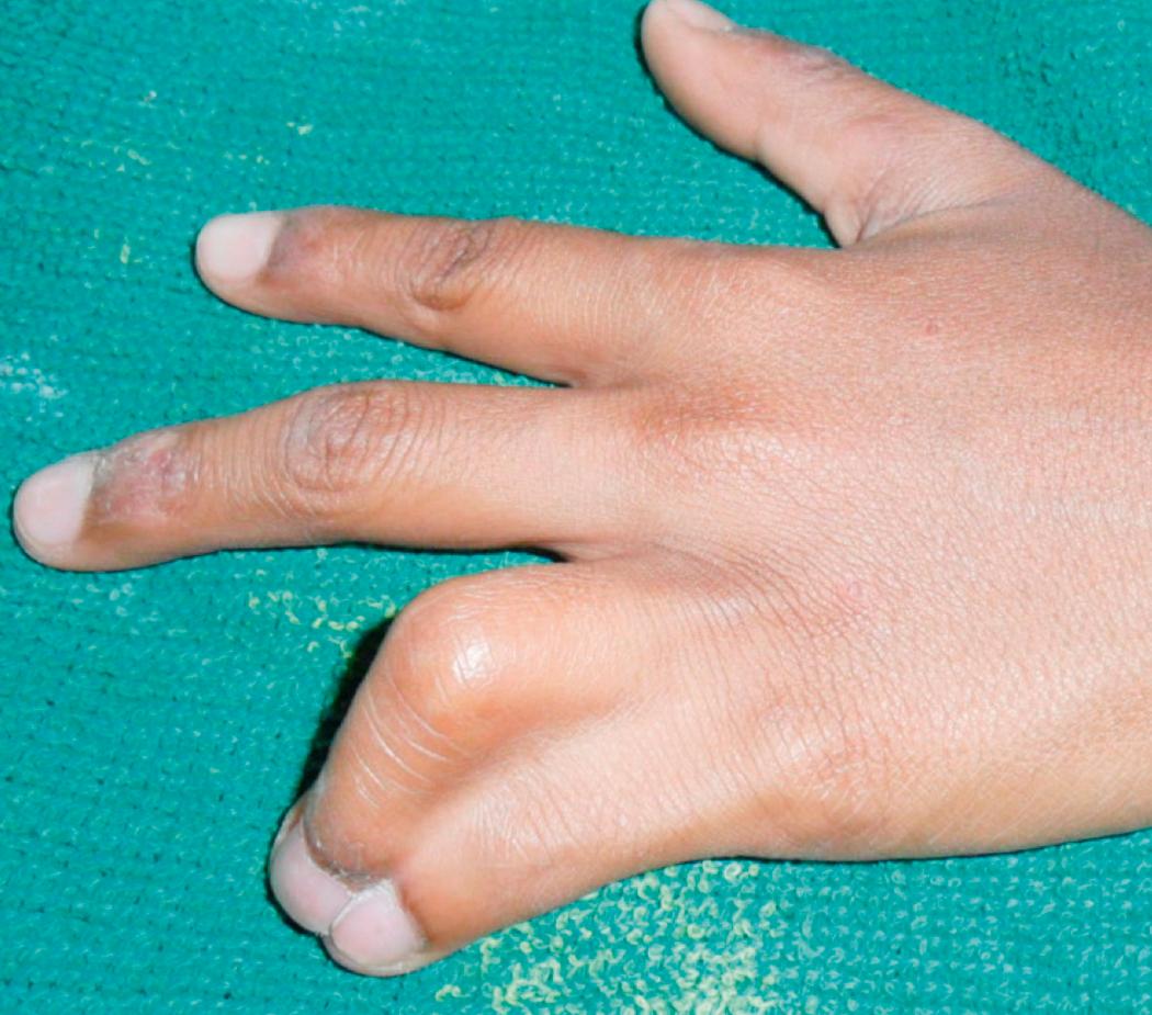 Fig. 36.4, Annular digital flexion and rotation deformity as a result of little finger tethering in the context of fourth commissure syndactyly. Web release is recommended early.