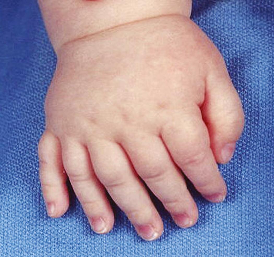 Fig. 36.41, A 1-year-old with central polydactyly consisting of five fingers with full motion and function.