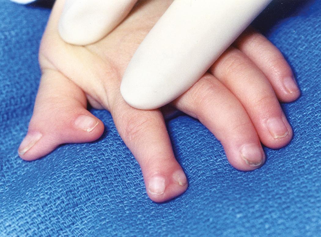 Fig. 36.42, Partial index finger polydactyly with concomitant thumb duplication.