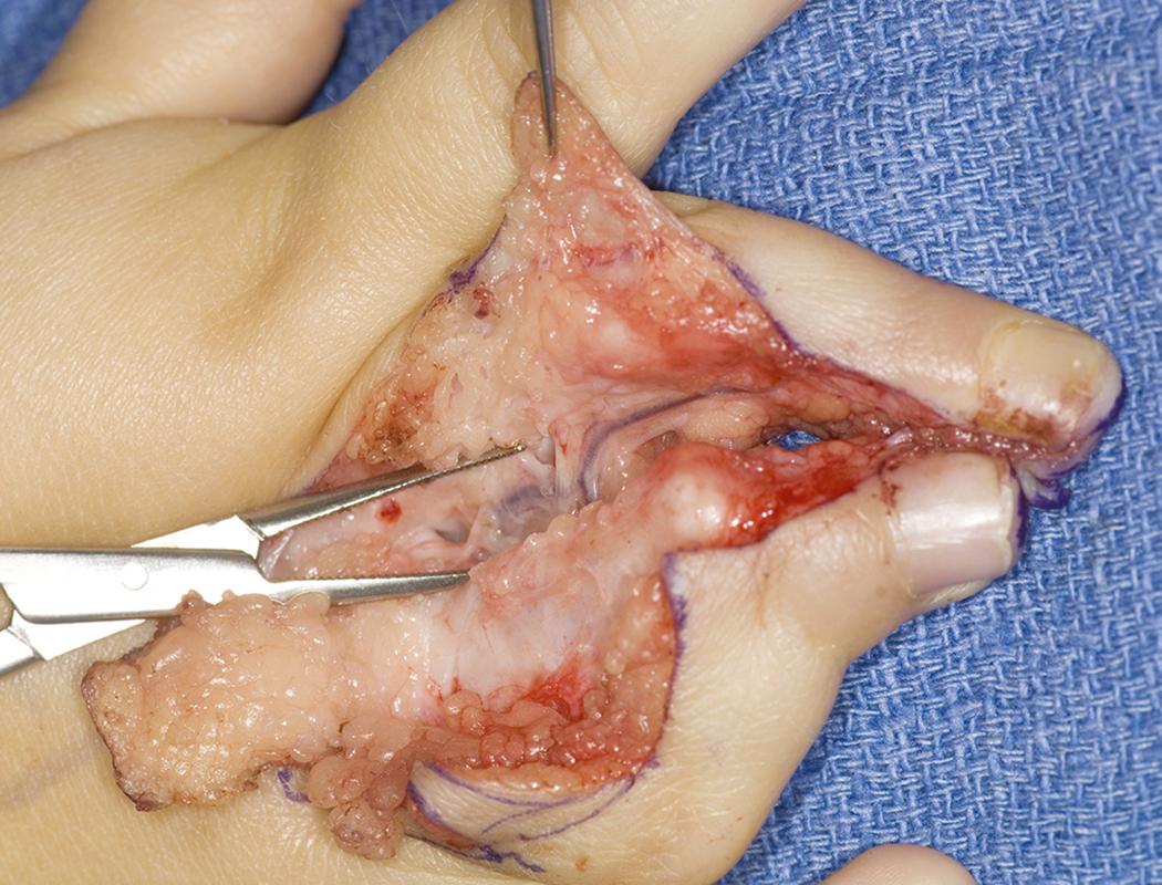 Fig. 36.43, Child depicted in Fig. 36.37 treated with a wide dorsal exposure to isolate the underlying bony elements and neurovascular structures.