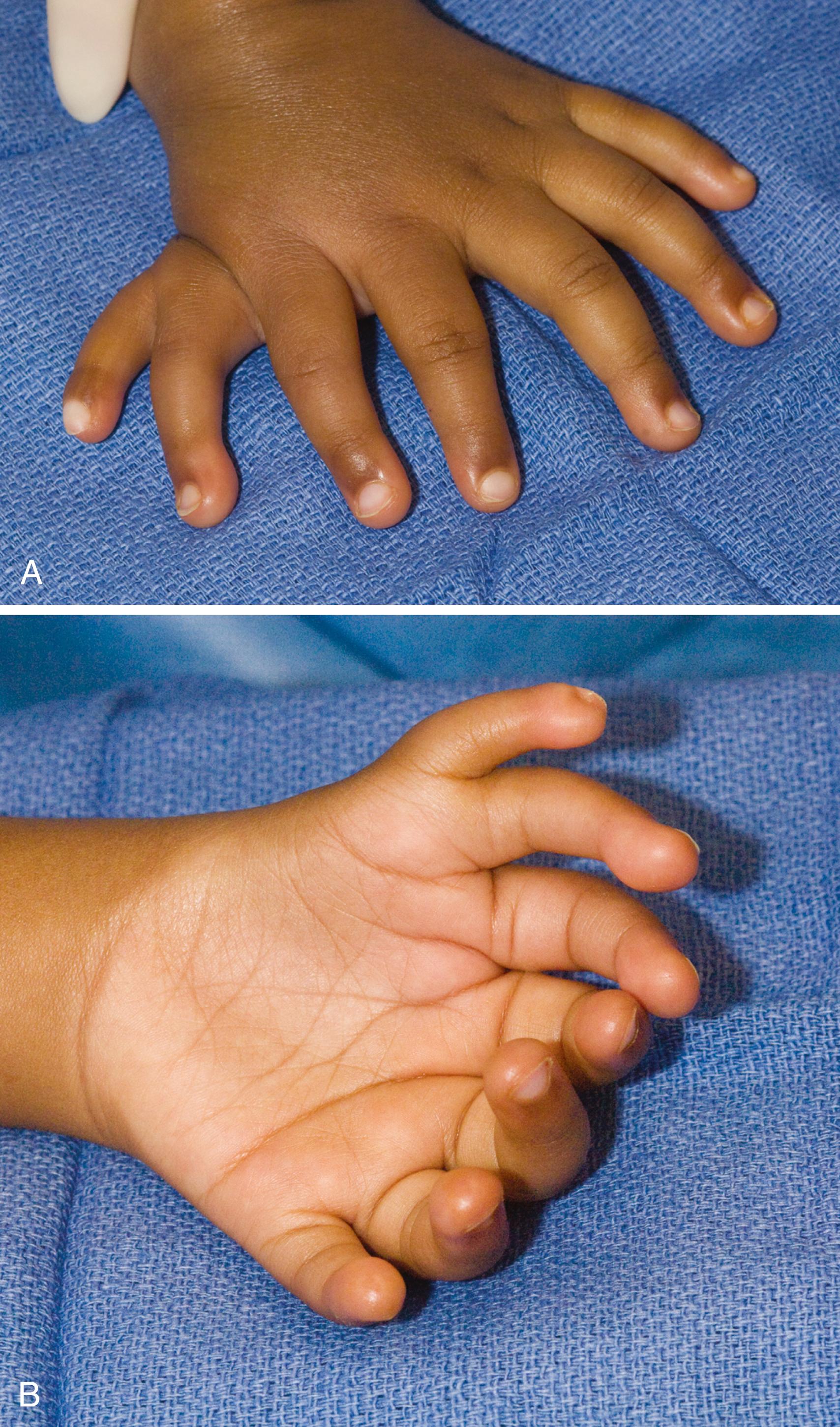 Fig. 36.46, A and B, A 1-year-old girl with a left mirror hand and seven digits.