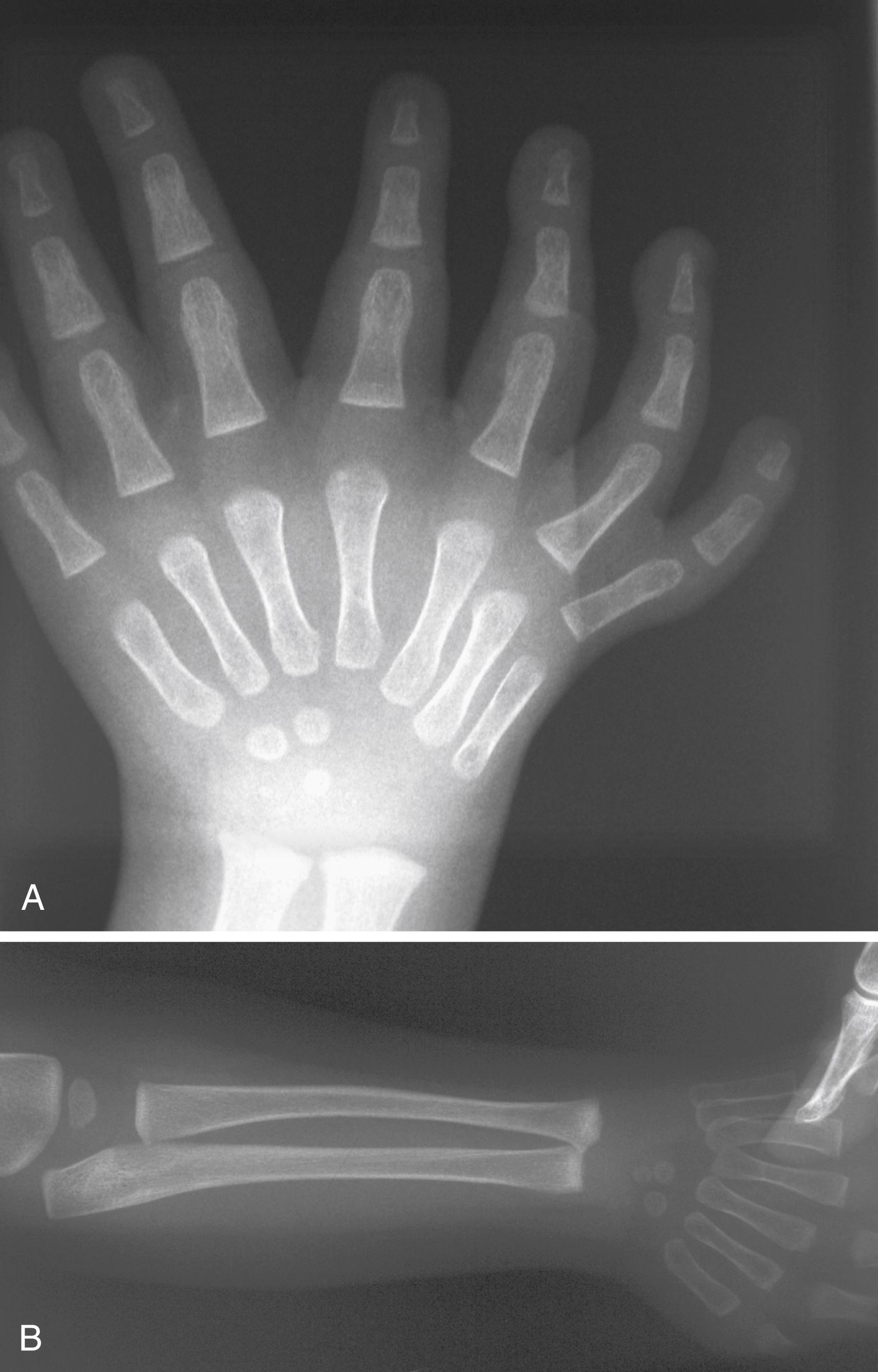 Fig. 36.47, A 2-year-old girl with a left mirror hand. A, Hand x-ray showing seven rays and early ossification of the ulnar carpus. B, Forearm x-ray showing two ulnae and no true radius.