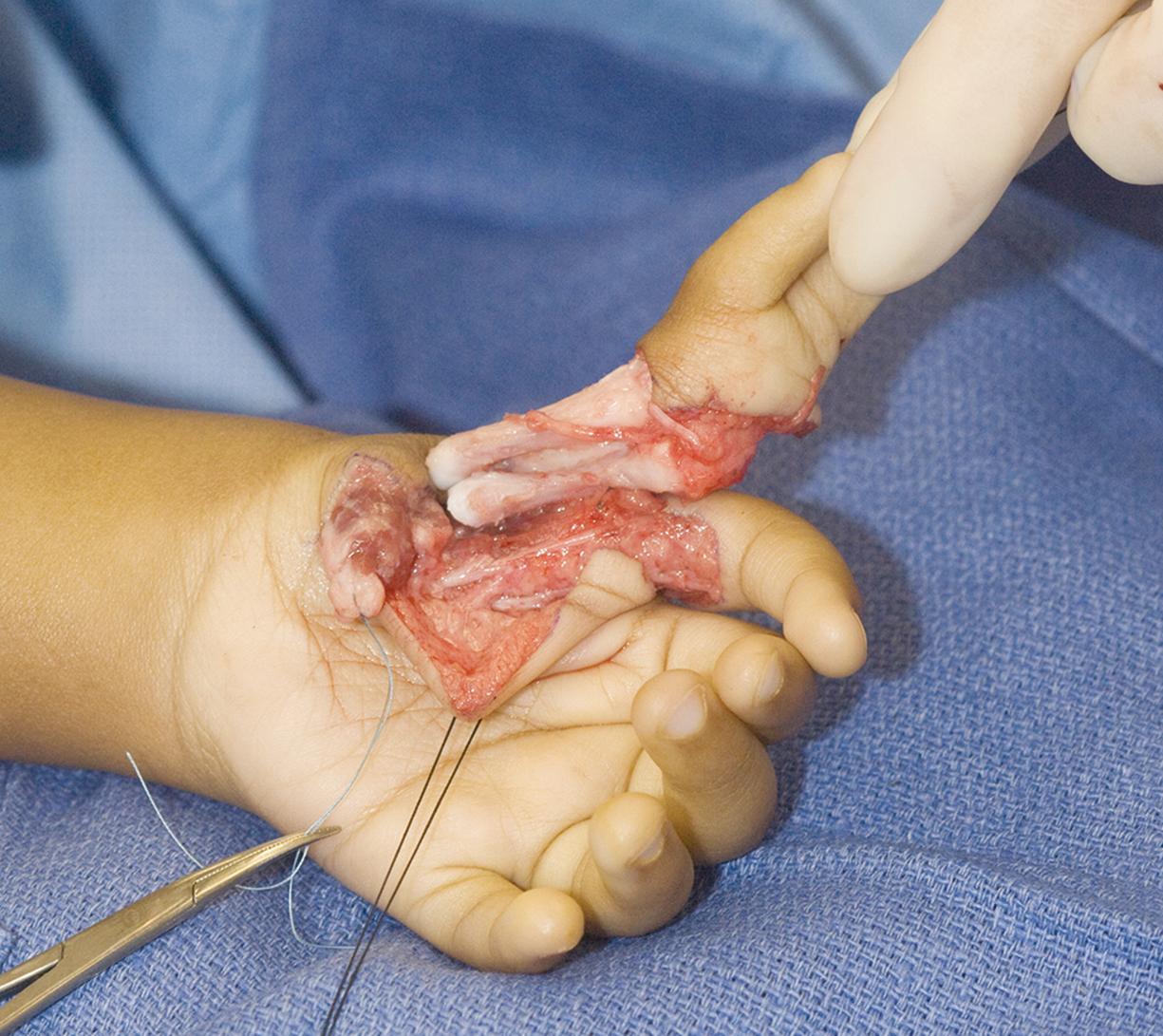 Fig. 36.49, Child depicted in Fig. 36.51 treated by ablation of the most radial two digits at the time of pollicization.