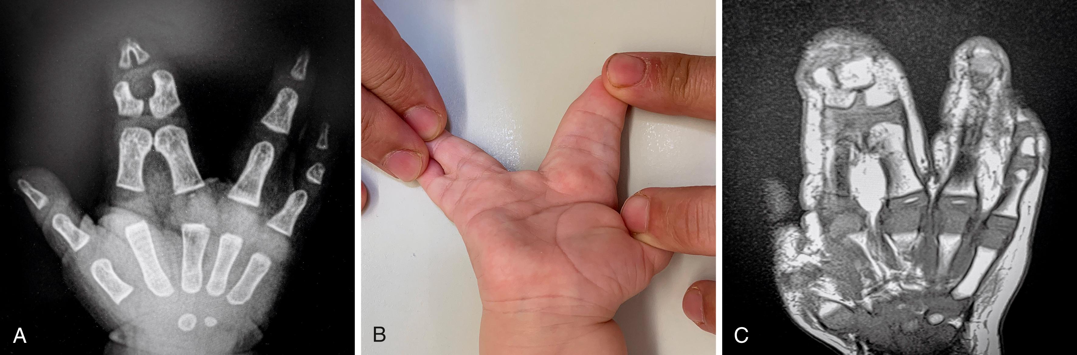 Fig. 36.5, A and B, Double syndactyly involving the second web with a complete complicated type and fourth web with a partial simple one. Magnetic resonance imaging (MRI) showed that the proximal interphalangeal (PIP) joint is shared between index and middle finger (C) . Separation would have two inconveniences: (1) the need of collateral ligament reconstruction that might result in residual instability, (2) coronal plane deviations with a Z deformity of each digit that might need correction with osteotomy and residual deformities. Thus second web syndactyly release might not be recommended.