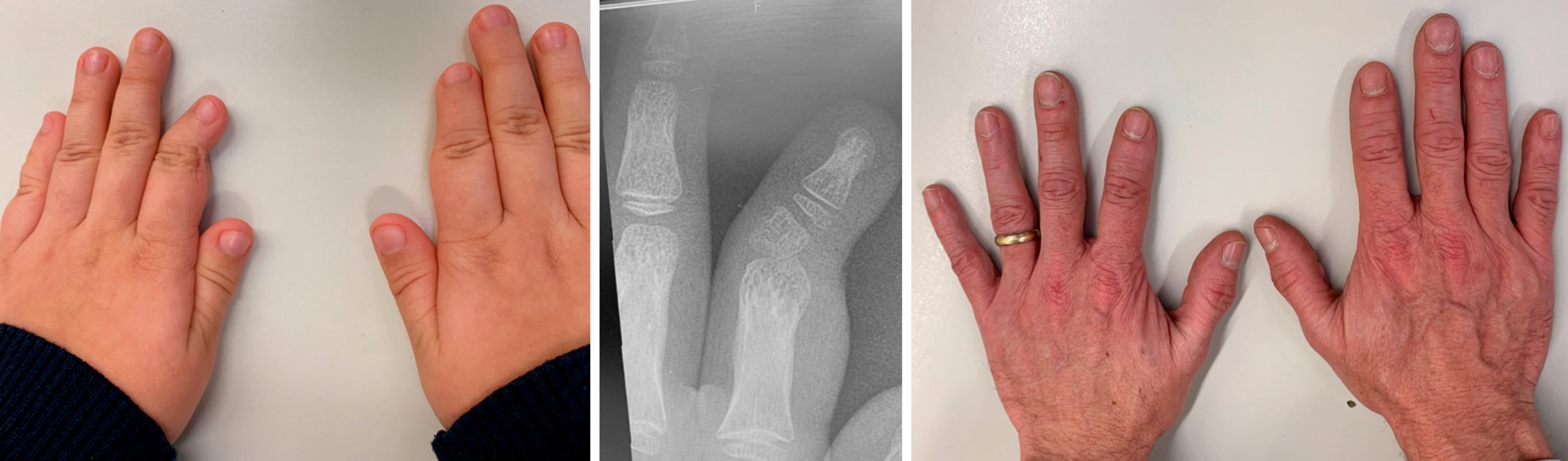 Fig. 36.52, Familial isolated brachydactyly.