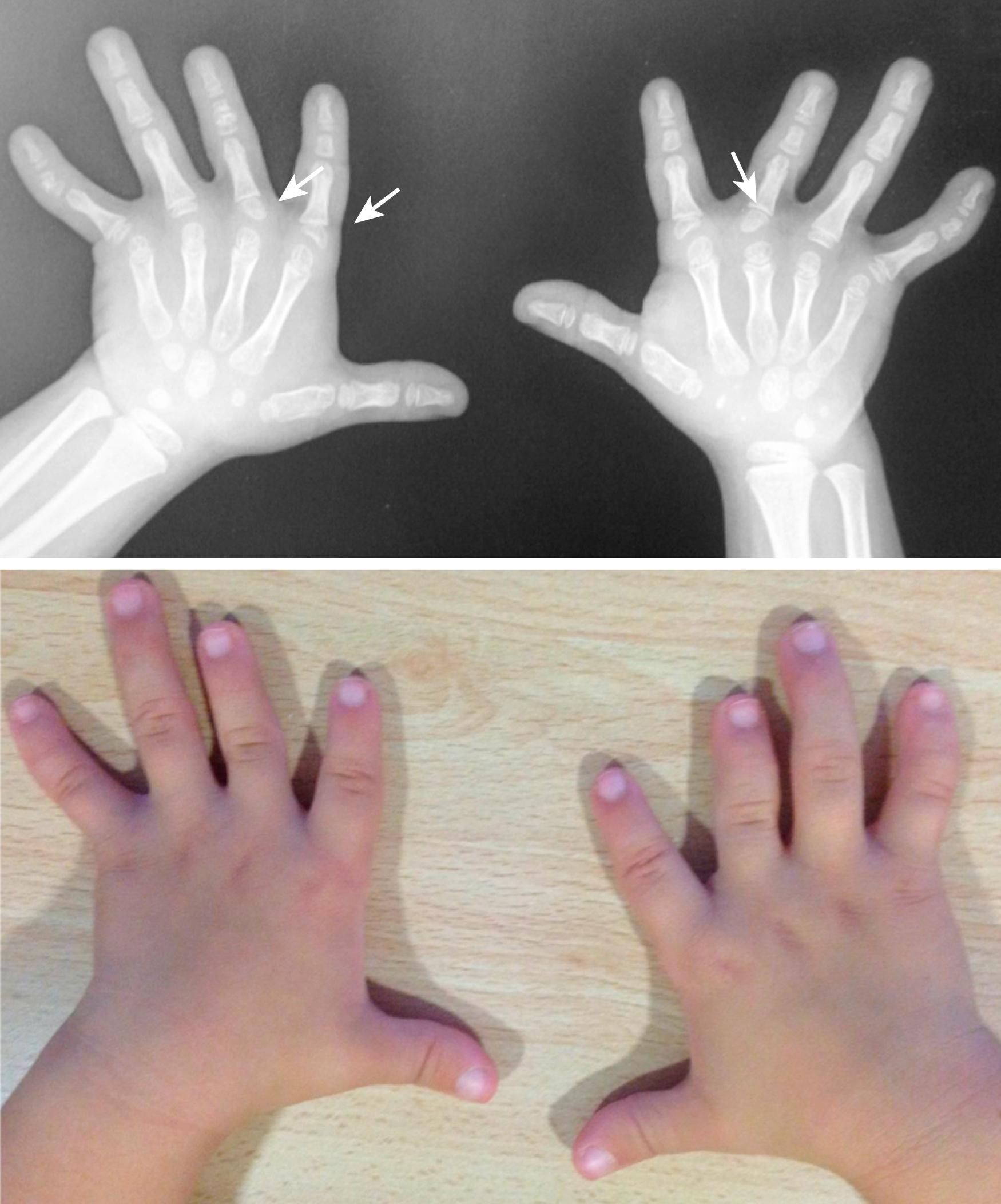 Fig. 36.54, Isolated brachydactyly with brachymesophalangia and first phalanx triangular-shaped epiphysis.