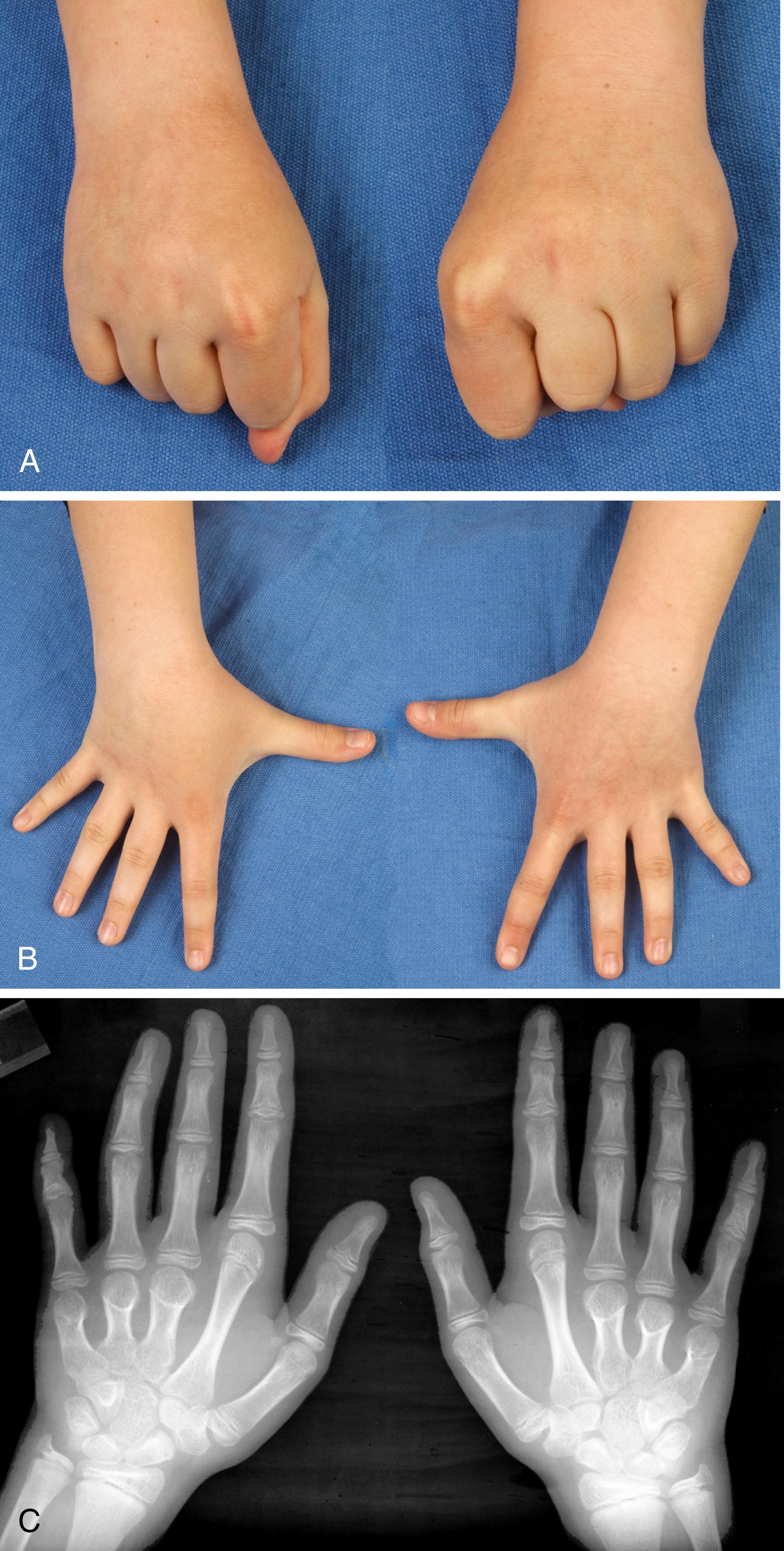 Fig. 36.55, A 10-year-old with isolated bilateral short long, ring, and small finger metacarpals. A, Loss of knuckle contour on fist formation. B, Shortened long, ring, and small fingers apparent on hand opening. C, X-rays with shortened long, ring, and small finger metacarpals.