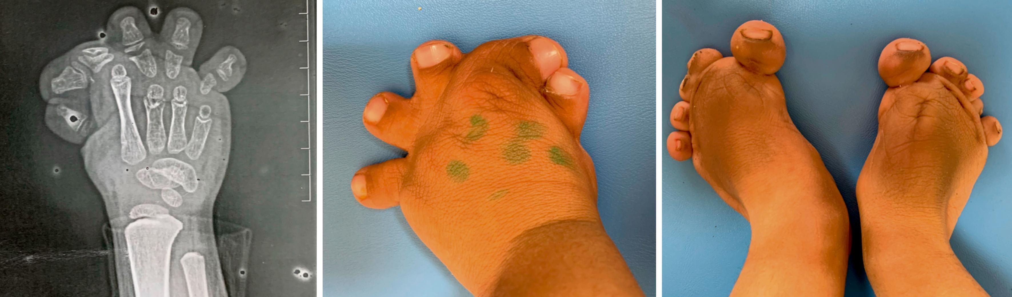 Fig. 36.56, Grebes’ chondrodysplasia with severe brachydactyly and central polydactyly that has been linked to a cartilage-derived morphogenetic protein deficiency.