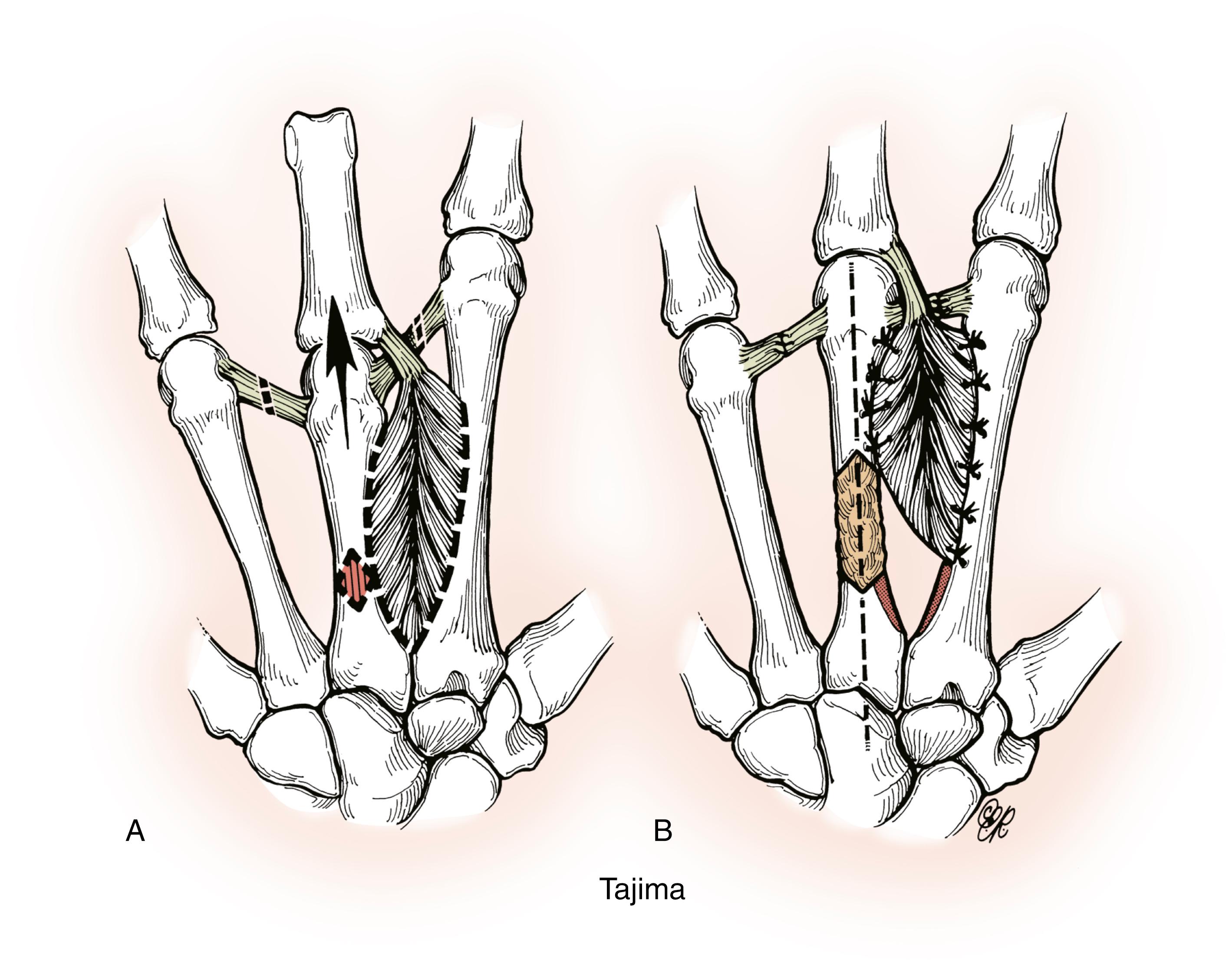 Fig. 36.58, A and B, Chevron-type slot graft used to lengthen the metacarpal, as described by Tajima.