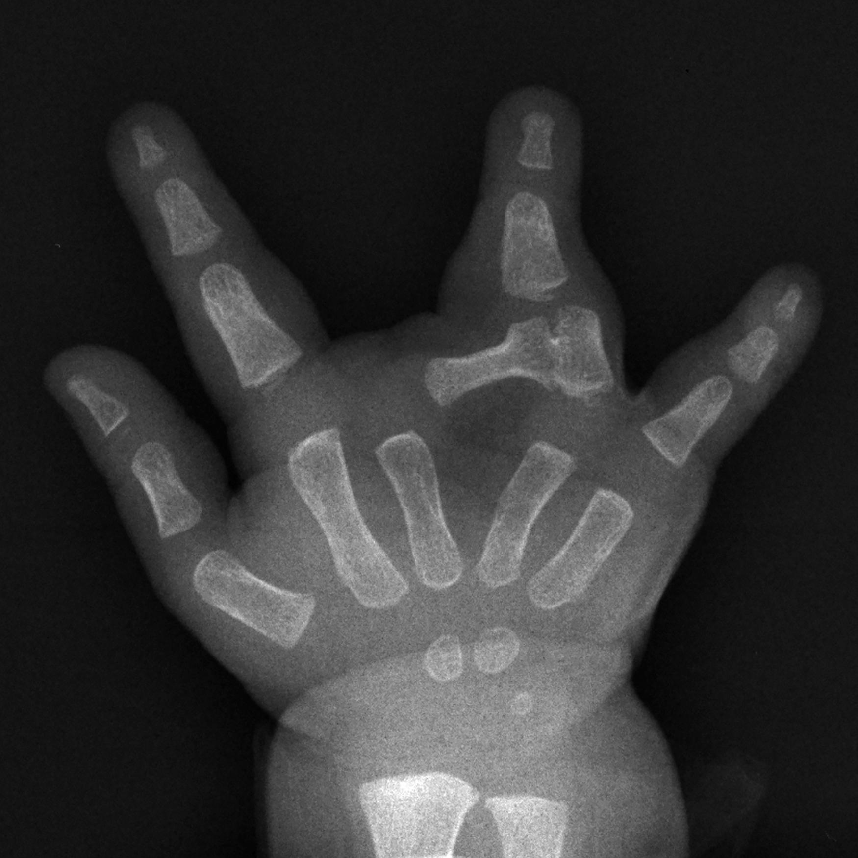 Fig. 36.60, X-ray of a 3-year-old with cleft hand. Anteroposterior view shows a proximal phalanx within the cleft oriented in a transverse direction.