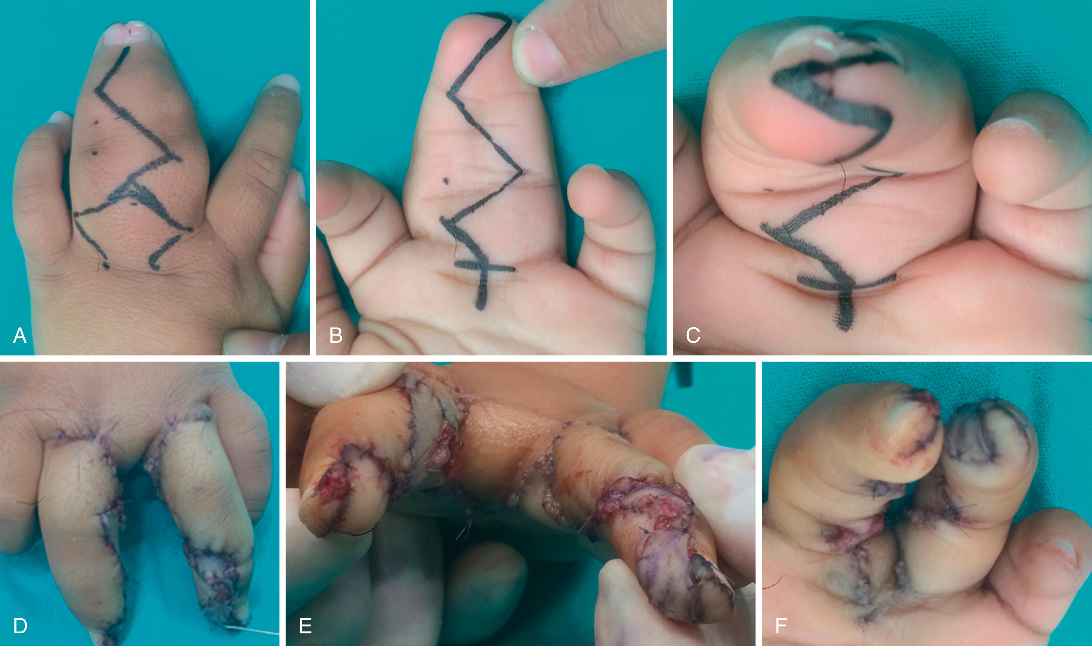 Fig. 36.6, Graftless seagull flap technique. Excess skin that is obtained from the dorsum of the proximal phalanges is shifted to the commissure and base of the fingers ( A and B ). Complex forms of syndactyly might require a skin graft just at the distal digit ( D and E ). Synonychia required Buck-Gramcko coronal skin flaps across the tip of the conjoined digits to reconstruct the nail fold ( C and F ). Preoperative torsion deformity of the digit can arise after release and may remain for some time (F) . Keloid formation is common in separated digits that exhibit macrodactyly, as in this case. Close follow-up is warranted to establish medical treatment.