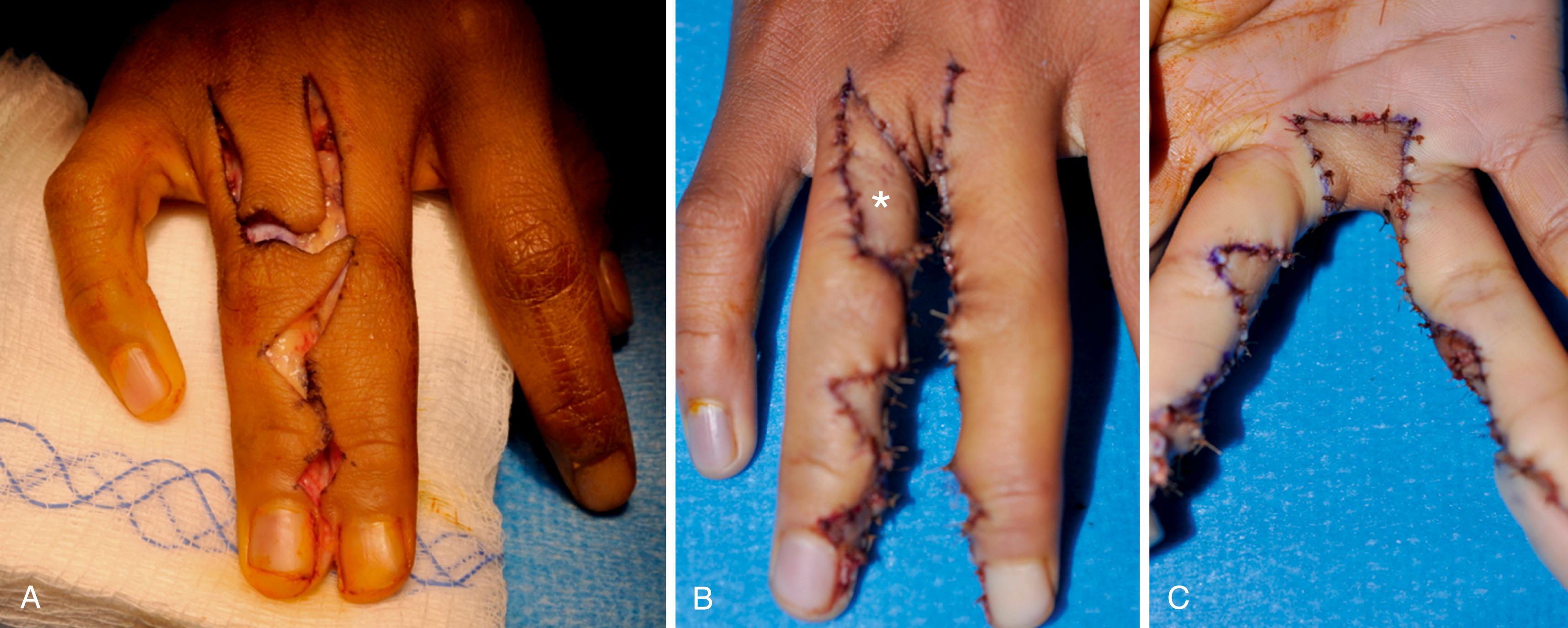 Fig. 36.9, Classic technique for syndactyly separation combining skin flaps with total-thickness skin graft (∗). Digits are separated using zigzag incisions (A) . Commissure is reconstructed using a random flap ( B and C ). We prefer Bauer’s technique, which uses a large, trapezoidal dorsal flap to cover the commissure.