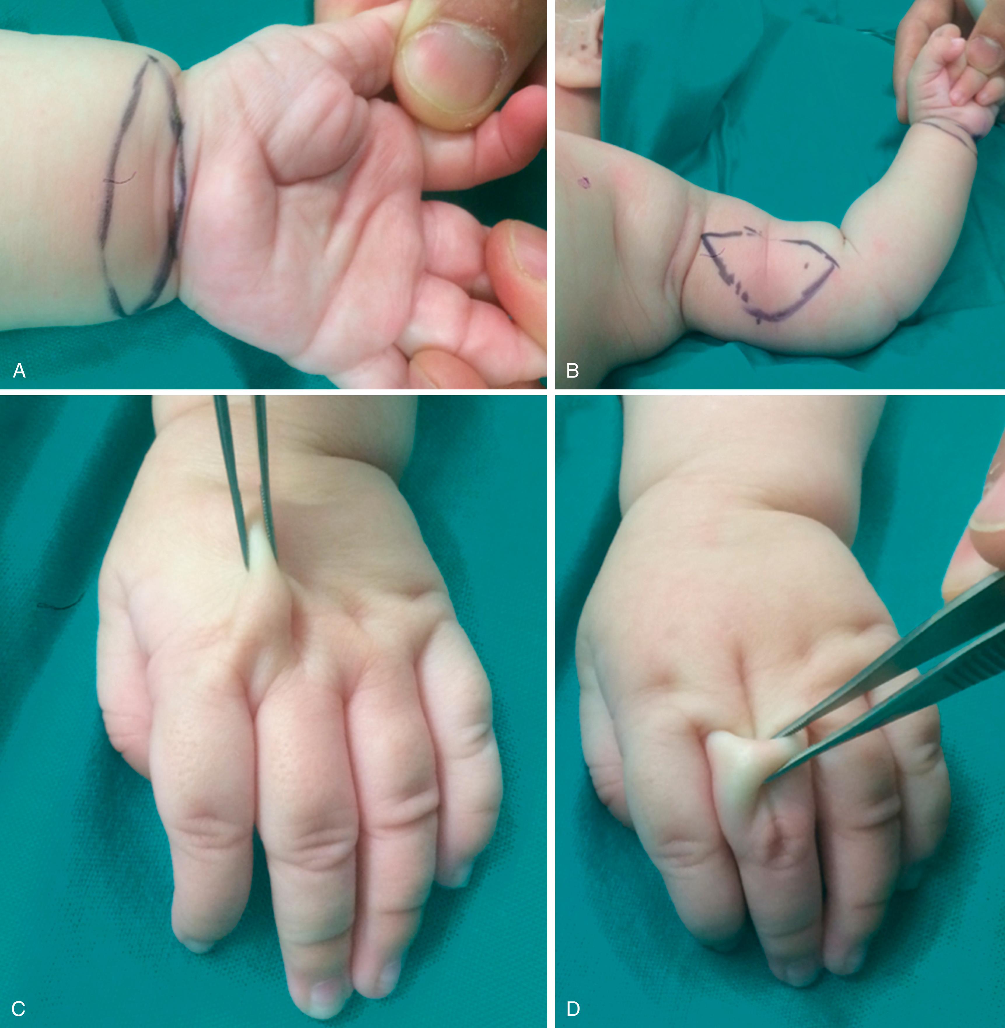 Fig. 36.10, Total-thickness skin graft obtained from the volar wrist provides an ideal color and texture match with digital skin (A) . Similar quality skin can be obtained from the medial arm when a large quantity of skin is needed (B) . Extra skin from the dorsum of the hand (C) or digits (D) can be shifted to the commissure and base of the fingers in a graftless manner.