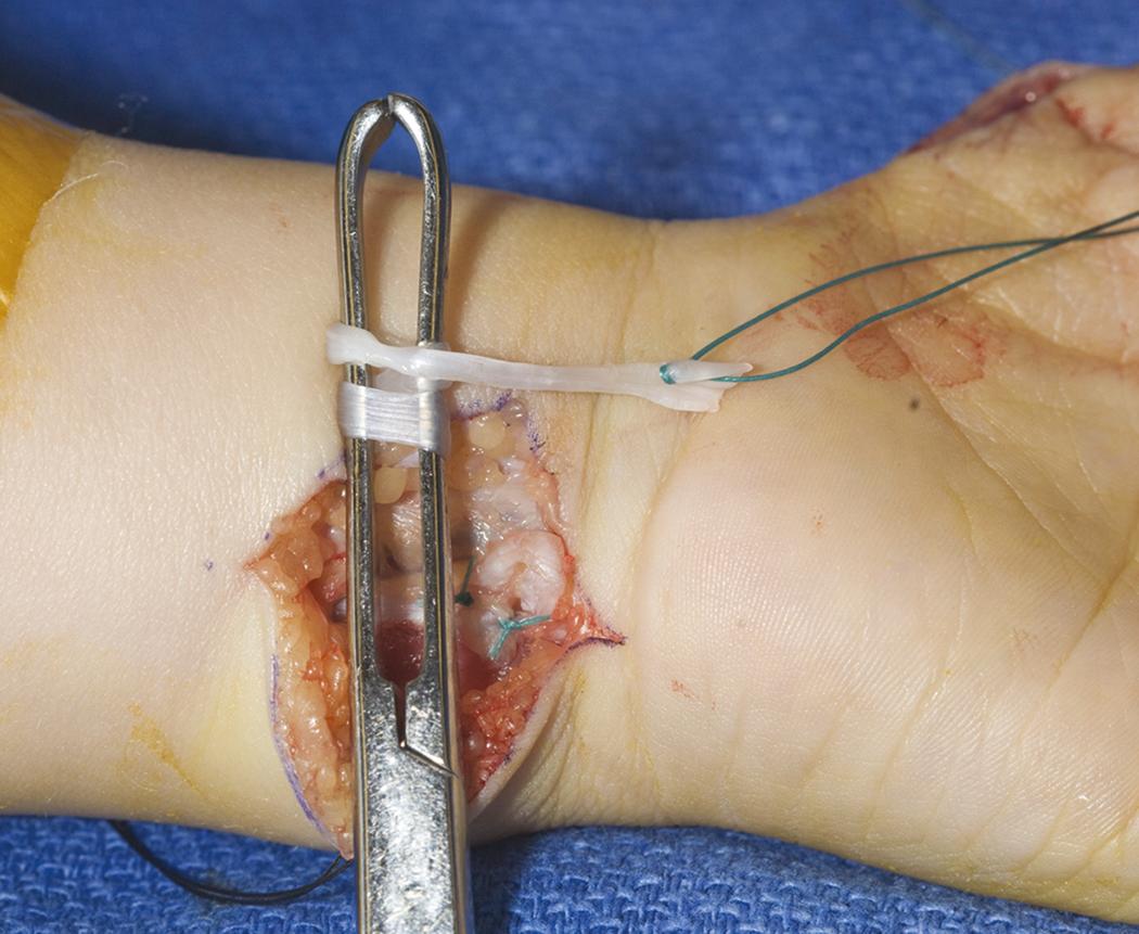 Fig. 37.9, Ring finger flexor digitorum superficialis tendon rolled into volar forearm incision.