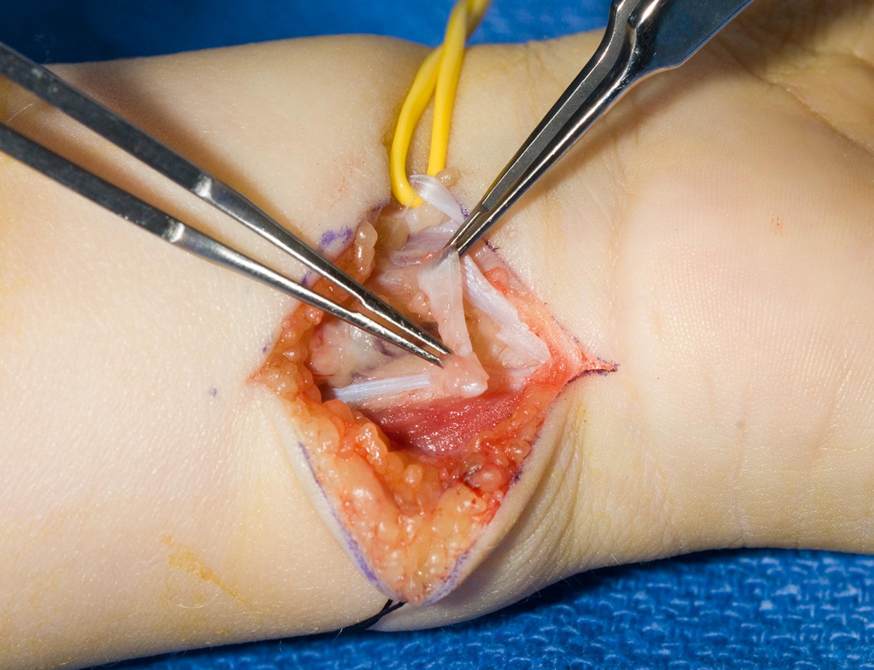 Fig. 37.10, One-half of the distal 2 to 3 cm of the flexor carpi ulnaris tendon is used to construct a pulley for the flexor digitorum superficialis tendon.