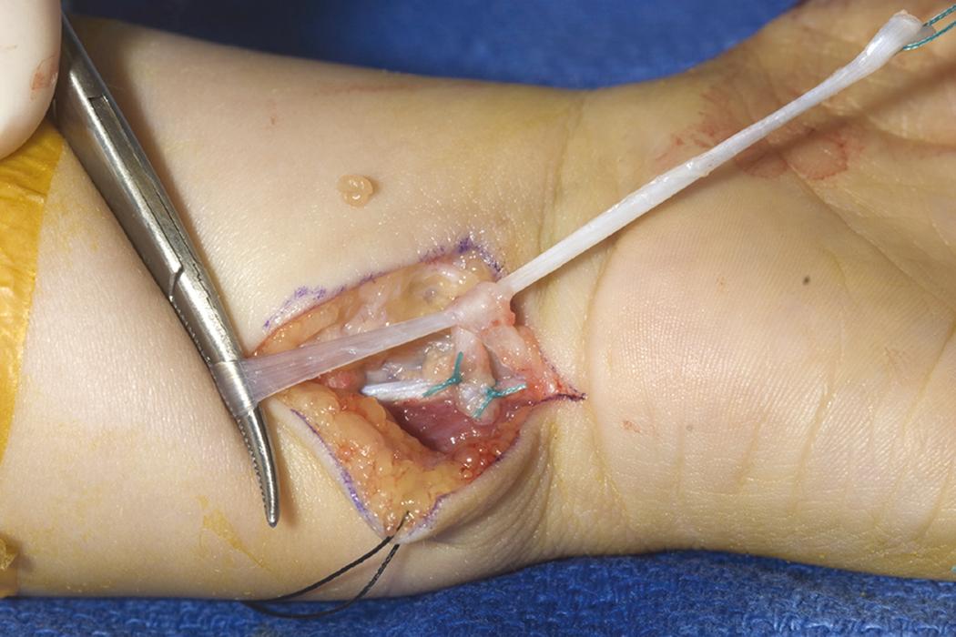 Fig. 37.11, Ring finger flexor digitorum superficialis tendon is passed through the flexor carpi ulnaris loop.