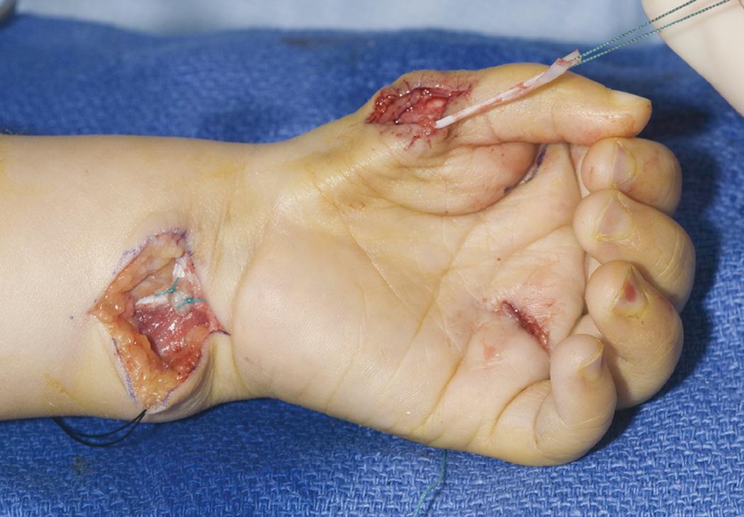 Fig. 37.12, The flexor digitorum superficialis tendon is passed through the subcutaneous tunnel to the radial side of the thumb.