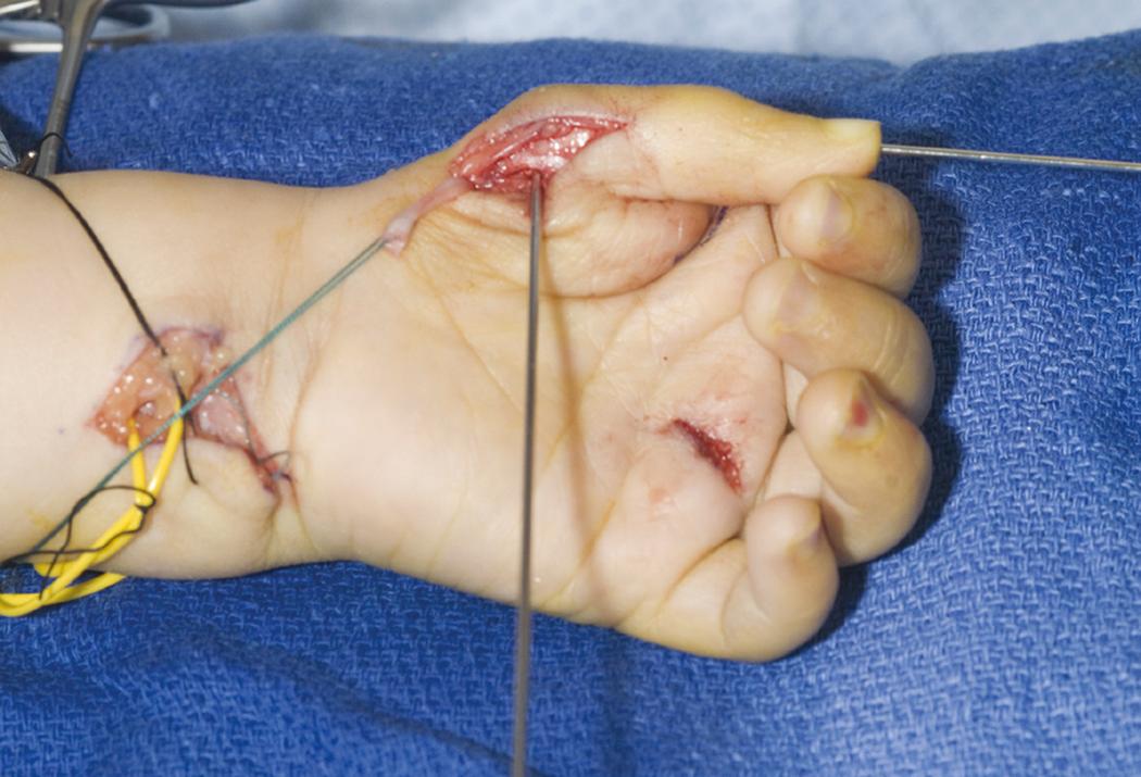 Fig. 37.13, Kirschner wire is drilled across the metacarpal head parallel to the joint surface.