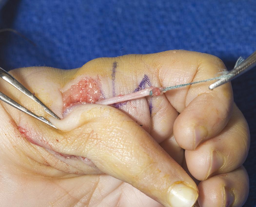 Fig. 37.14, Flexor digitorum superficialis tendon is passed through the metacarpal head to the ulnar side of thumb.