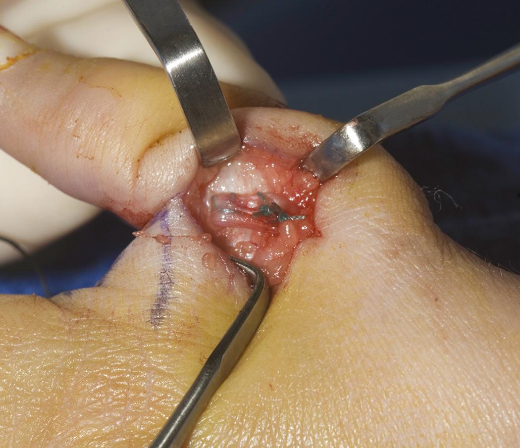 Fig. 37.15, Flexor digitorum superficialis tendon is used to reconstruct the ulnar collateral ligament. Note longitudinal Kirschner wire exiting tip of the thumb.