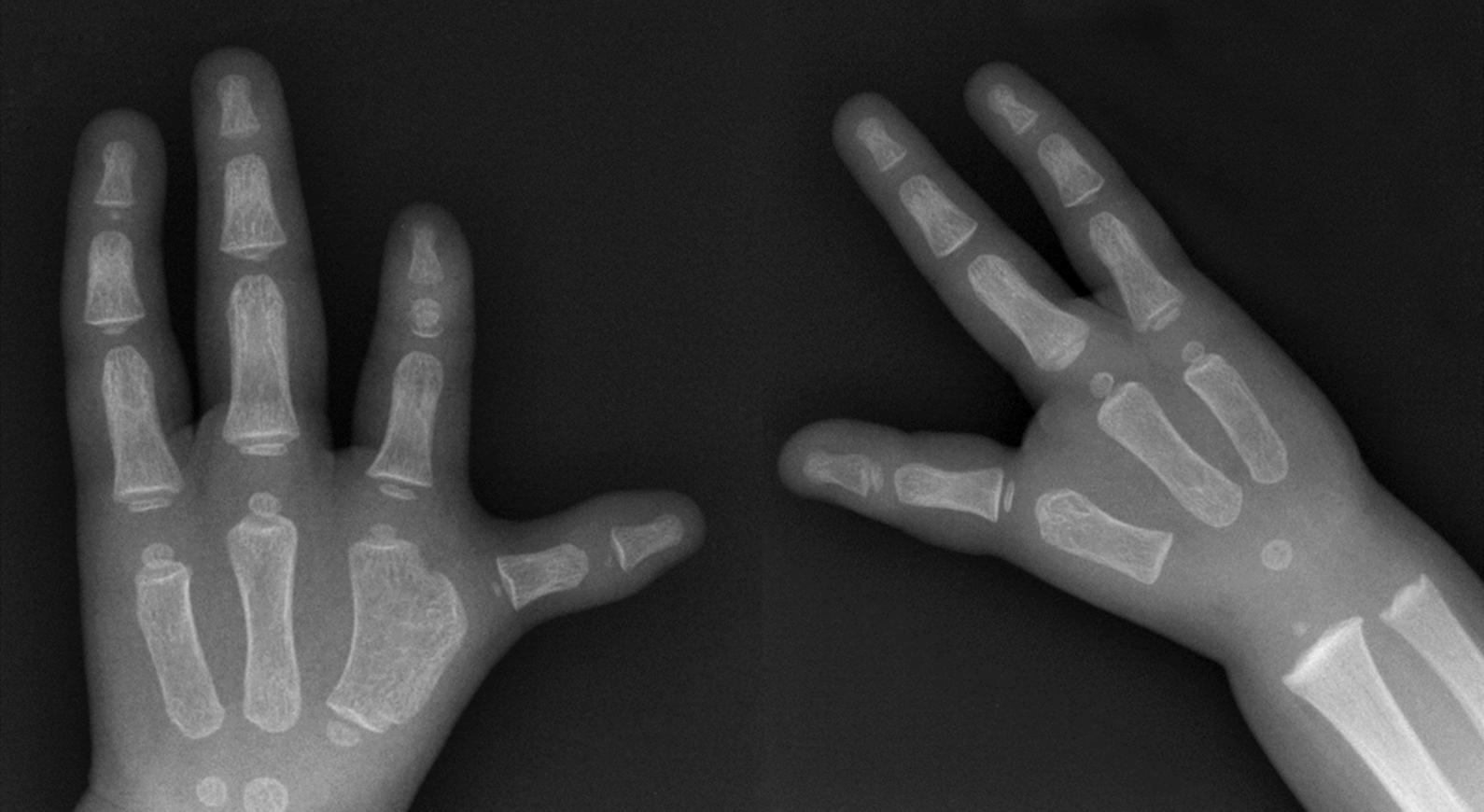 eFig. 37.4, Left thumb hypoplasia.